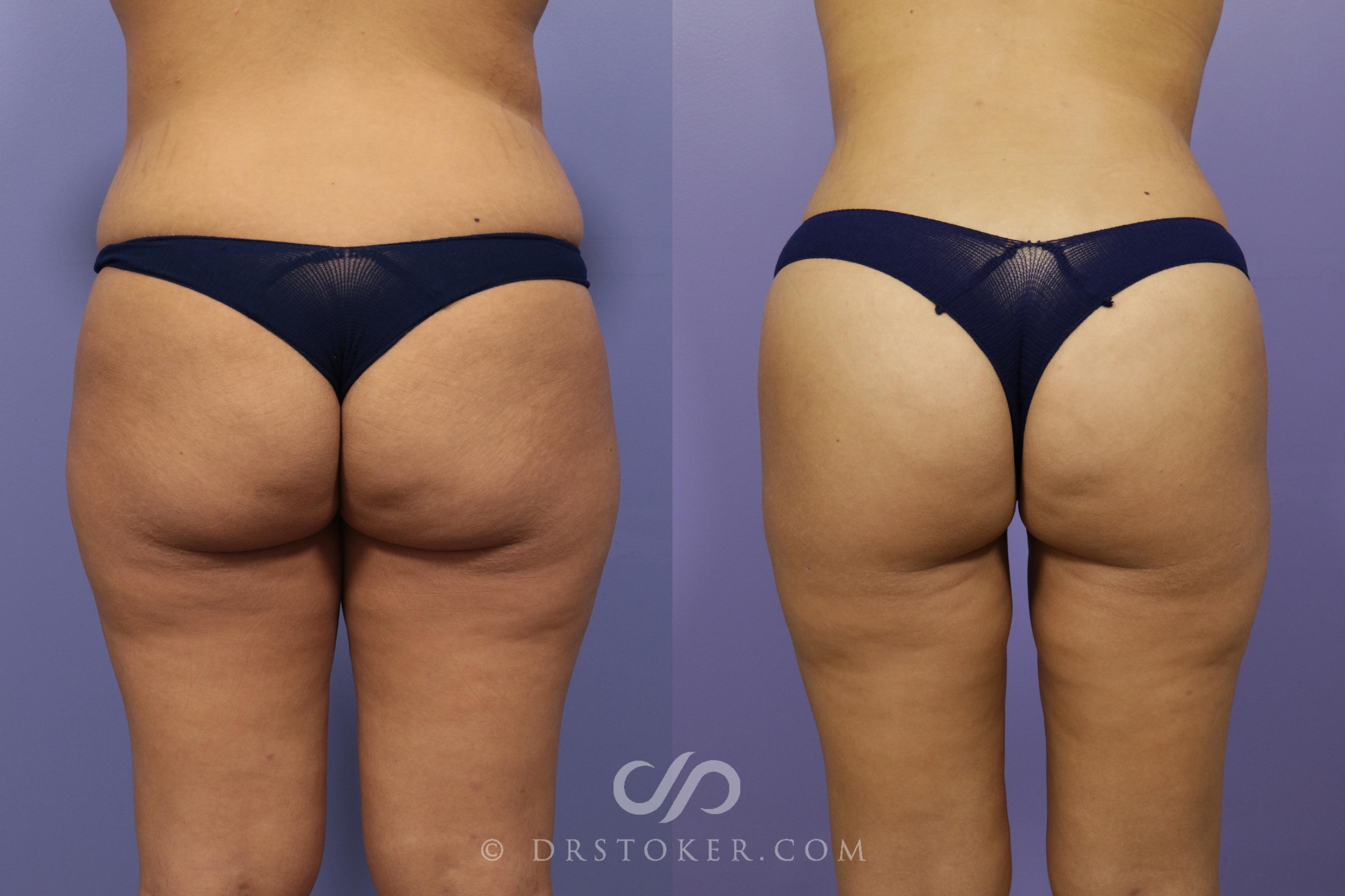 Before & After Brazilian Butt Lift (Fat Grafts to Buttocks) Case 1403 View #1 View in Los Angeles, CA