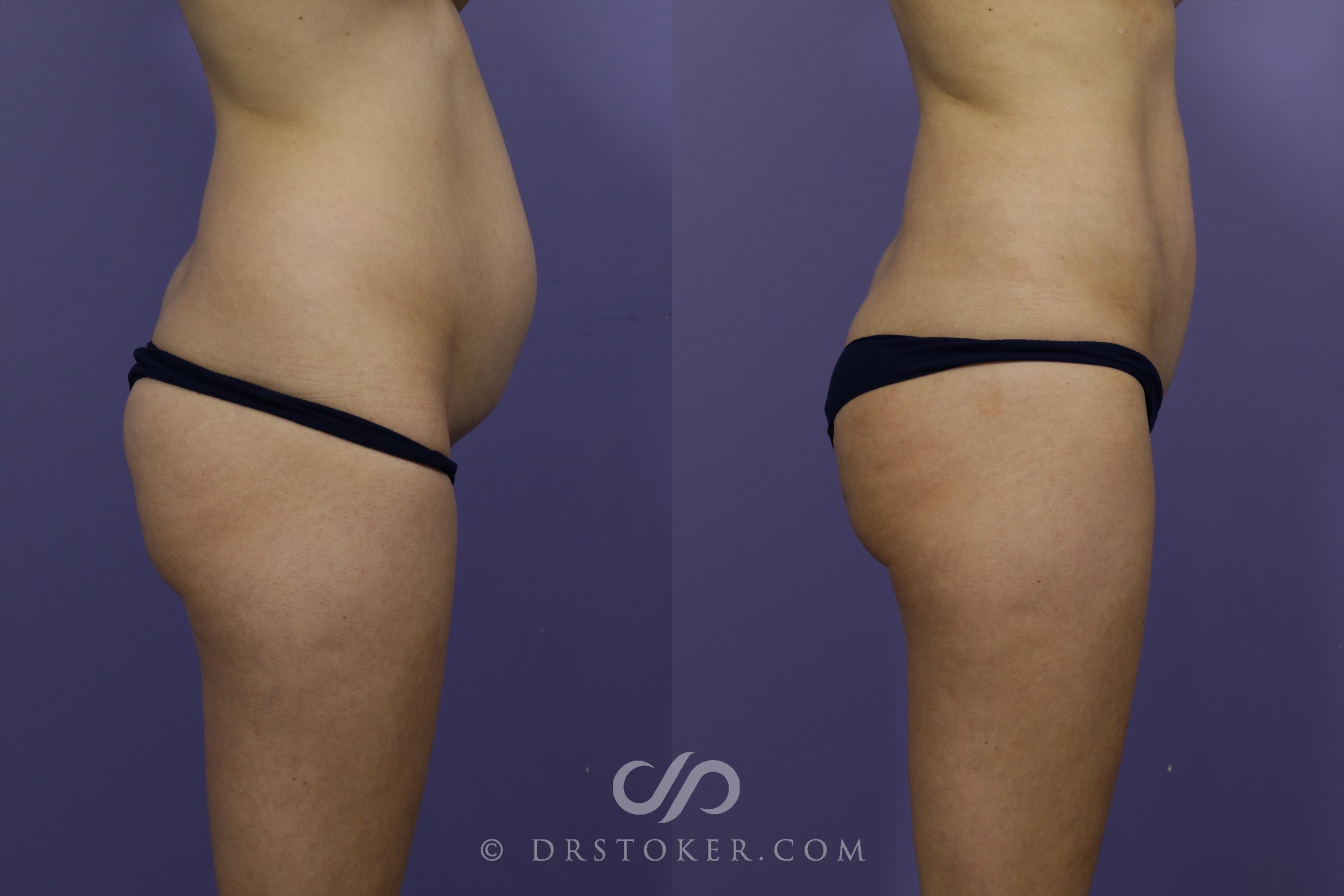 Before & After Brazilian Butt Lift (Fat Grafts to Buttocks) Case 1505 View #1 View in Los Angeles, CA