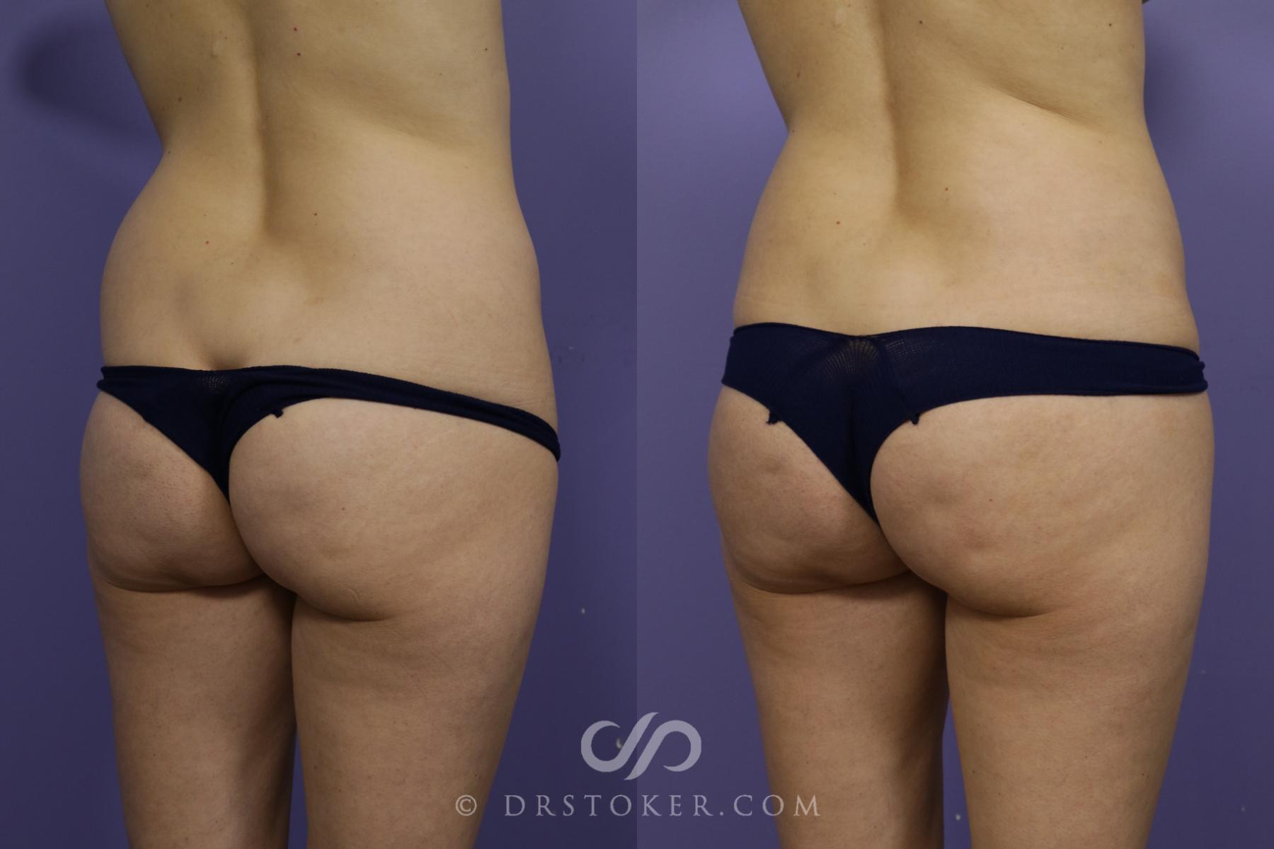 Before & After Brazilian Butt Lift (Fat Grafts to Buttocks) Case 1505 View #3 View in Los Angeles, CA