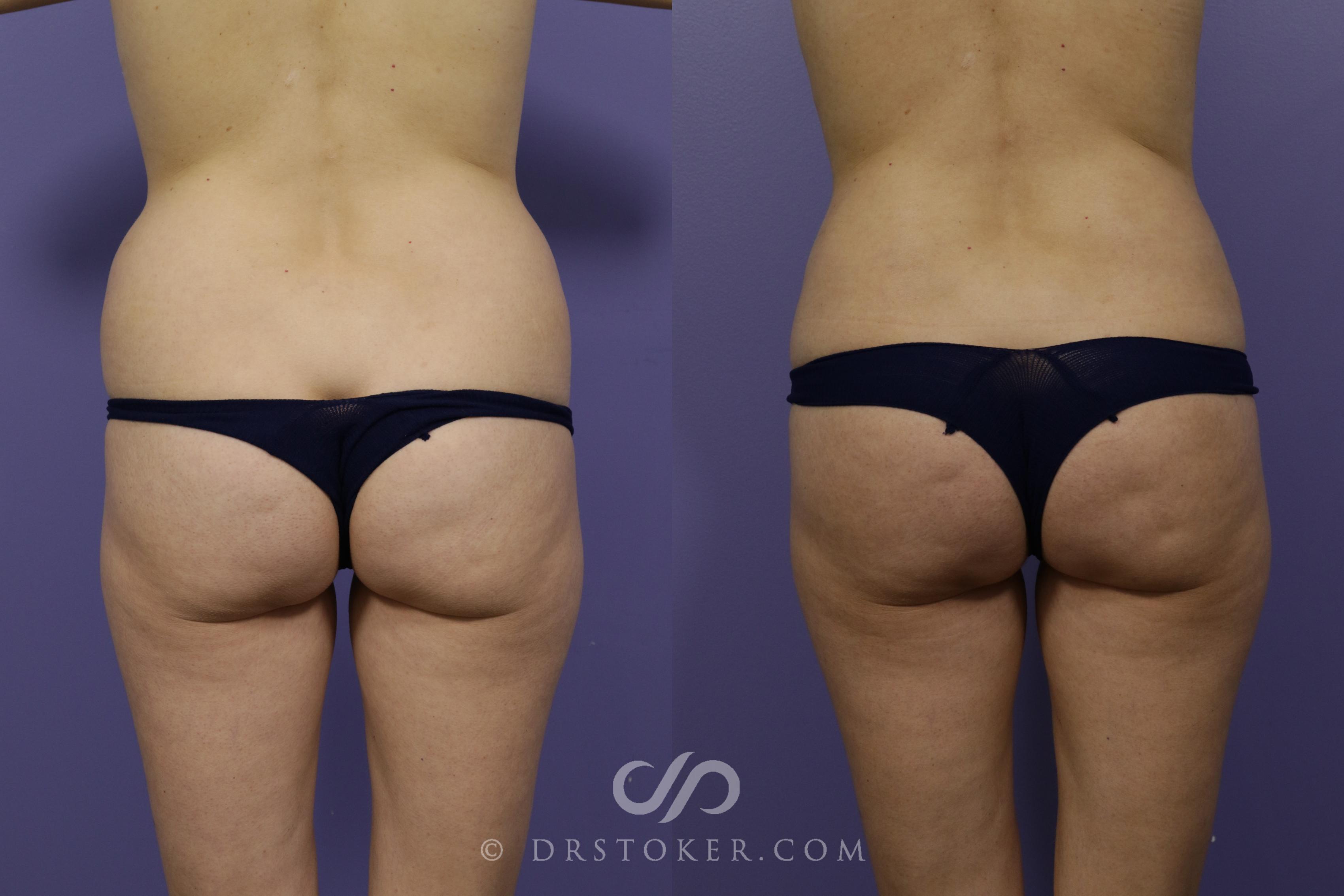 Before & After Brazilian Butt Lift (Fat Grafts to Buttocks) Case 1505 View #4 View in Los Angeles, CA