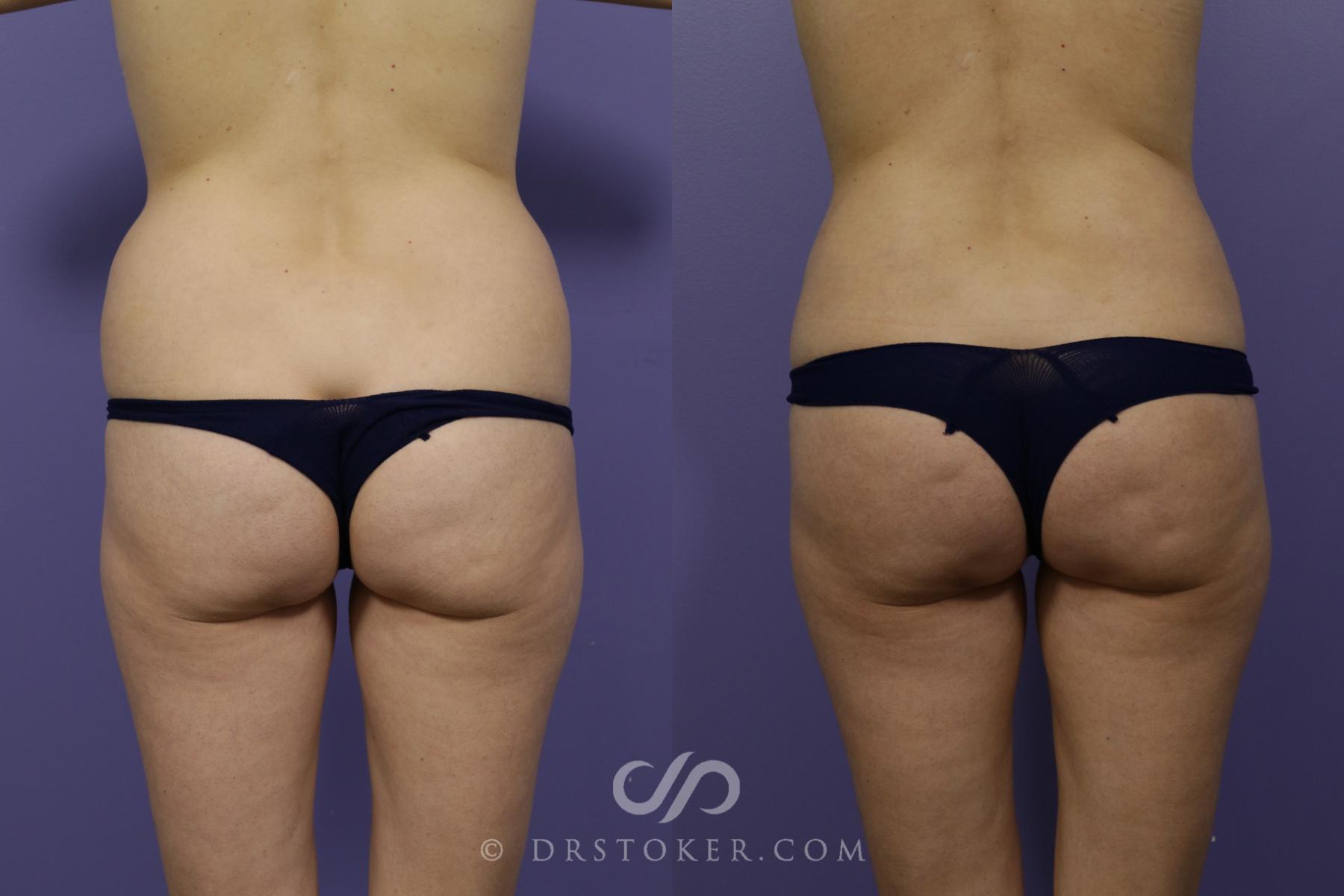 Before & After Brazilian Butt Lift (Fat Grafts to Buttocks) Case 1505 View #4 View in Los Angeles, CA