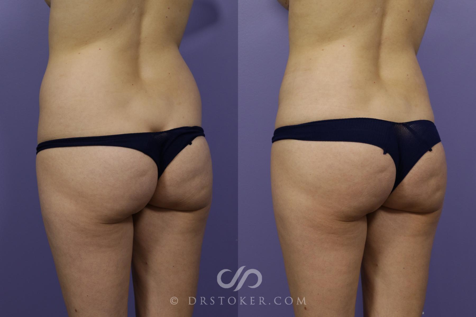 Before & After Brazilian Butt Lift (Fat Grafts to Buttocks) Case 1505 View #5 View in Los Angeles, CA