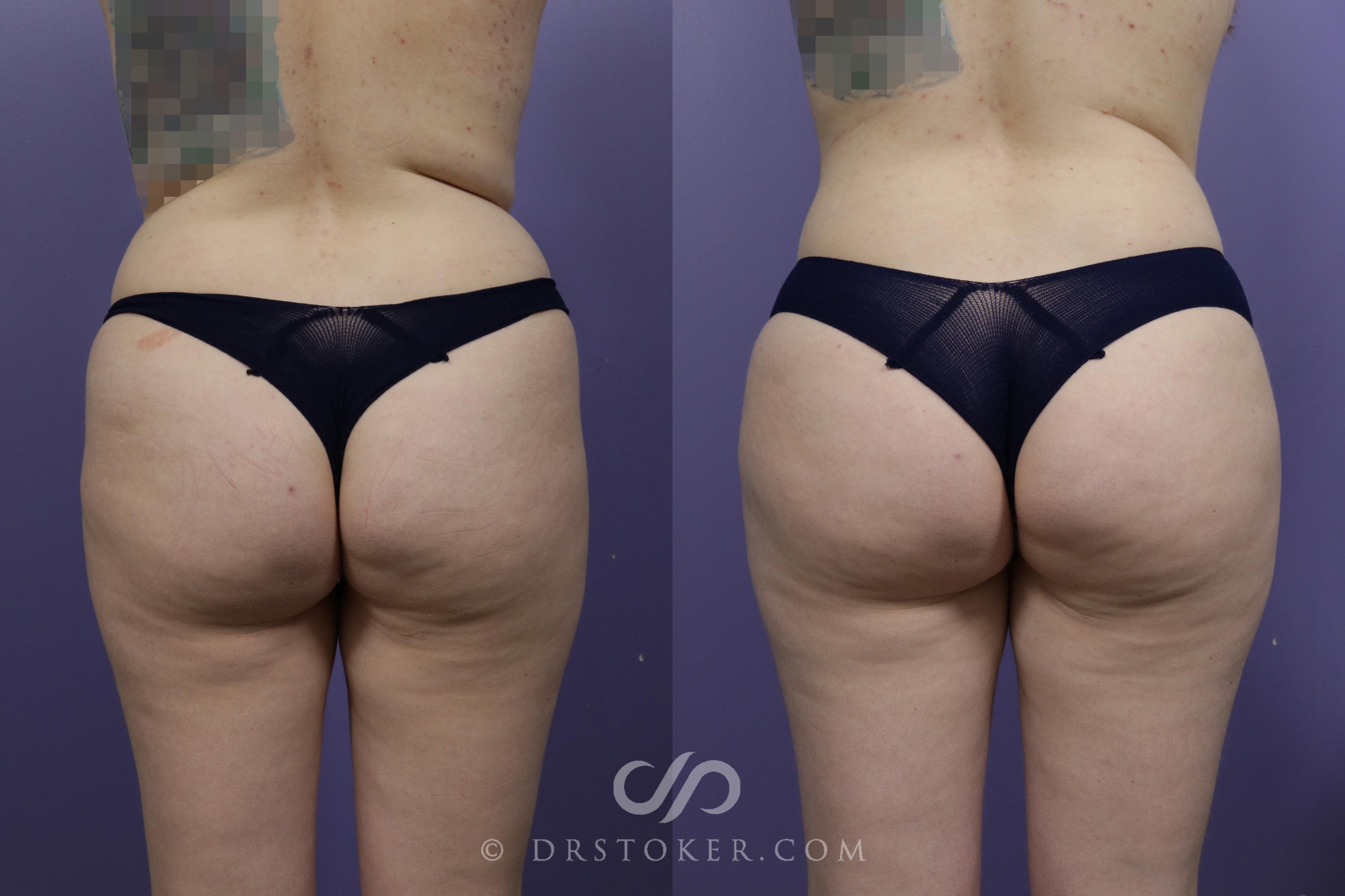 Before & After Brazilian Butt Lift (Fat Grafts to Buttocks) Case 1506 View #1 View in Los Angeles, CA