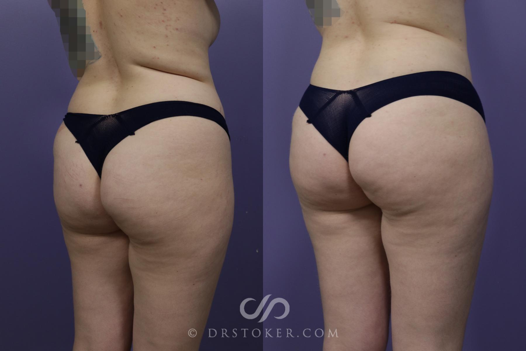 Before & After Brazilian Butt Lift (Fat Grafts to Buttocks) Case 1506 View #2 View in Los Angeles, CA