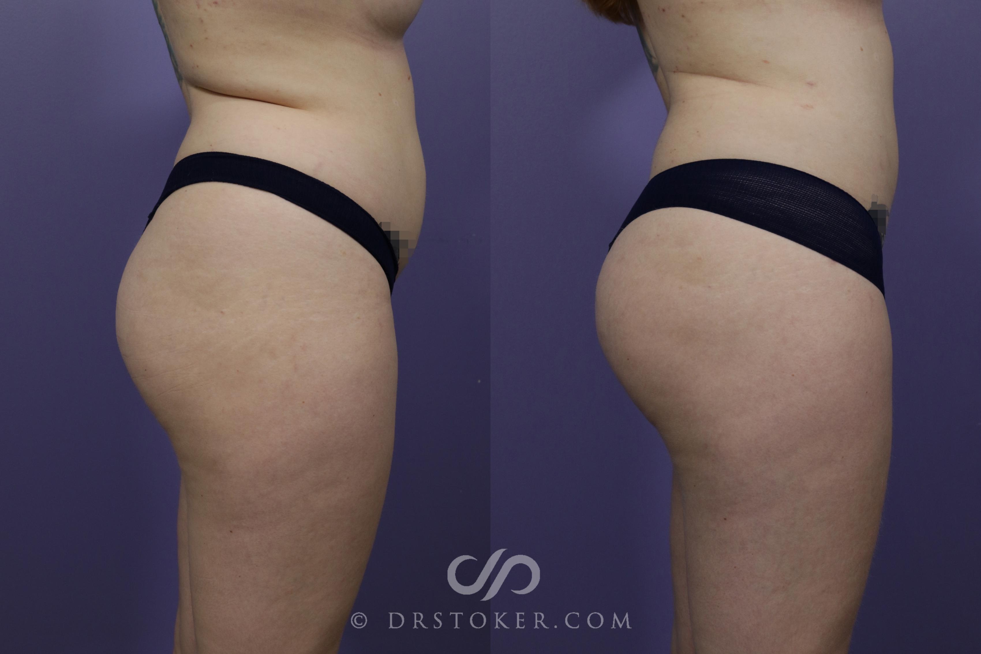 Before & After Liposuction - Abdominal Etching & Sculpting Case 1507 View #1 View in Los Angeles, CA