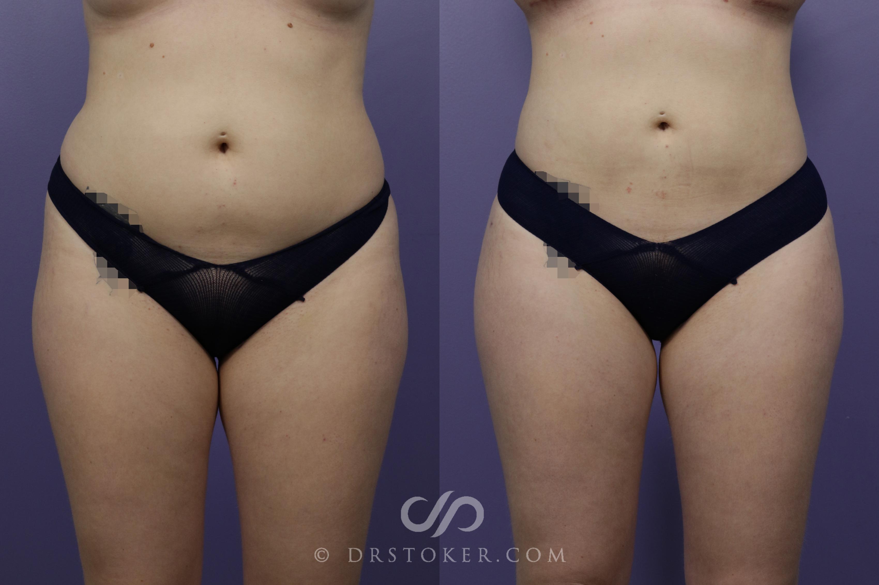 Before & After Brazilian Butt Lift (Fat Grafts to Buttocks) Case 1508 View #1 View in Los Angeles, CA