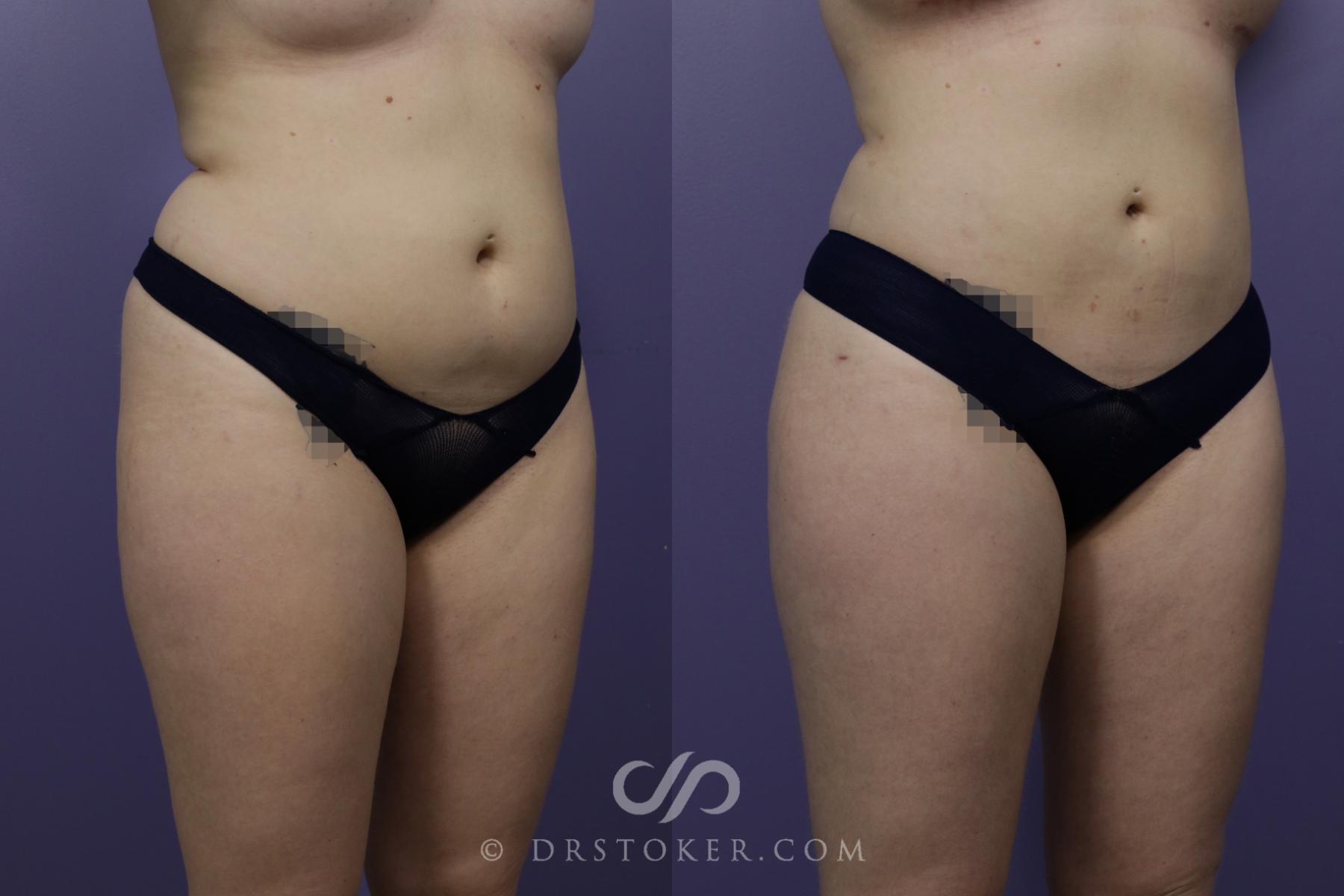 Before & After Brazilian Butt Lift (Fat Grafts to Buttocks) Case 1508 View #2 View in Los Angeles, CA