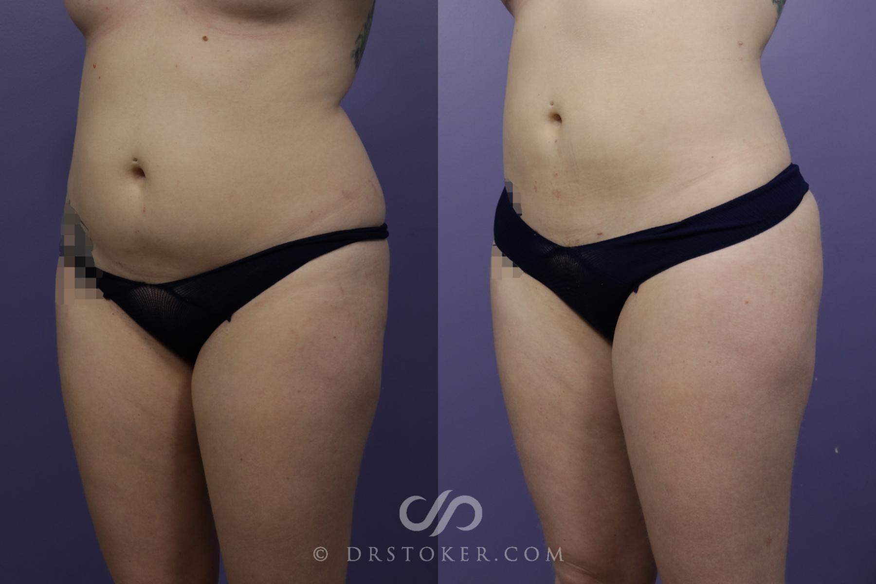 Before & After Liposuction Case 1508 View #3 View in Los Angeles, CA