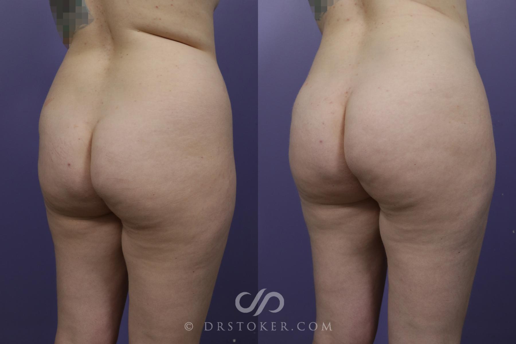 Before & After Liposuction Case 1511 View #1 View in Los Angeles, CA