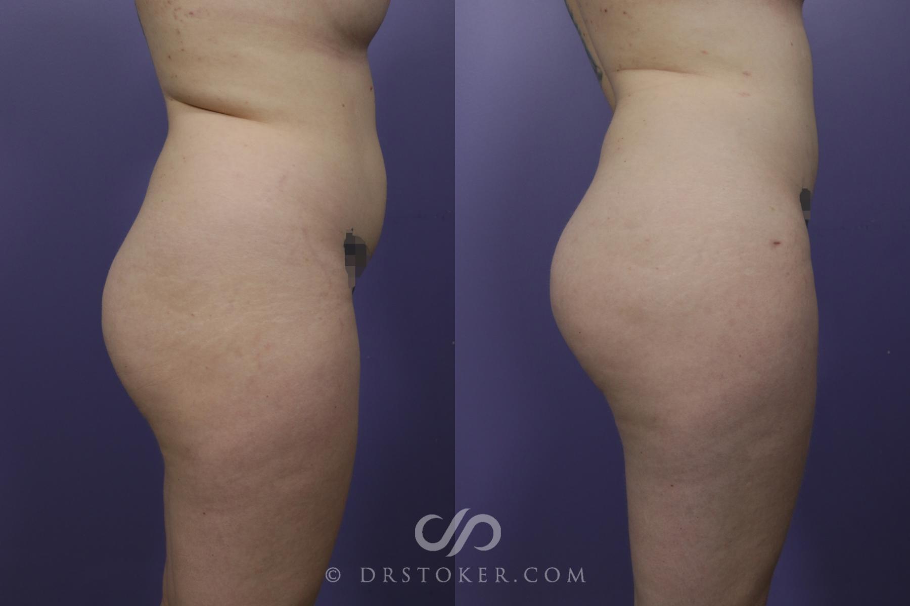 Before & After Brazilian Butt Lift (Fat Grafts to Buttocks) Case 1511 View #2 View in Los Angeles, CA