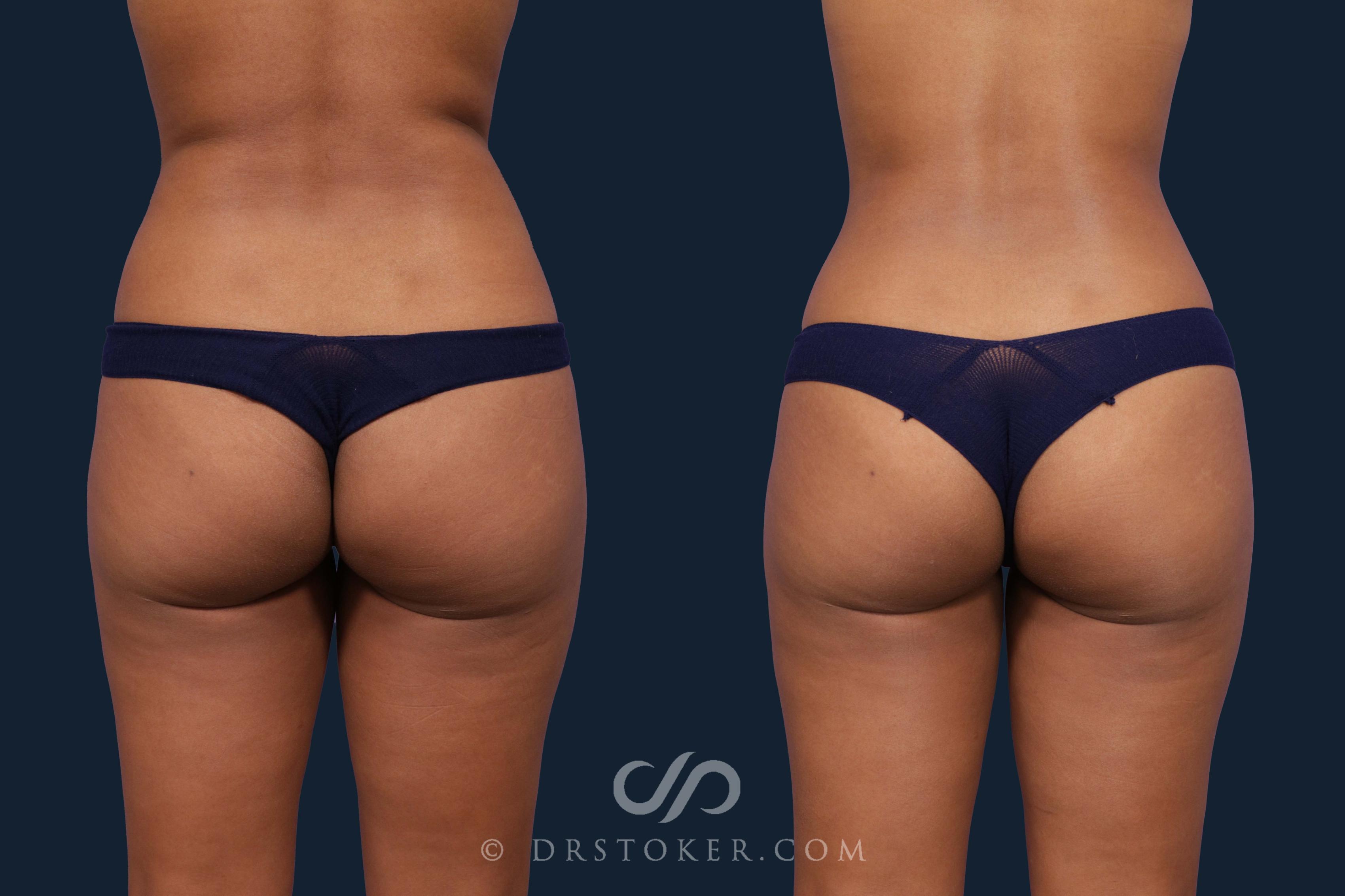 Before & After Brazilian Butt Lift (Fat Grafts to Buttocks) Case 2040 Back View in Los Angeles, CA