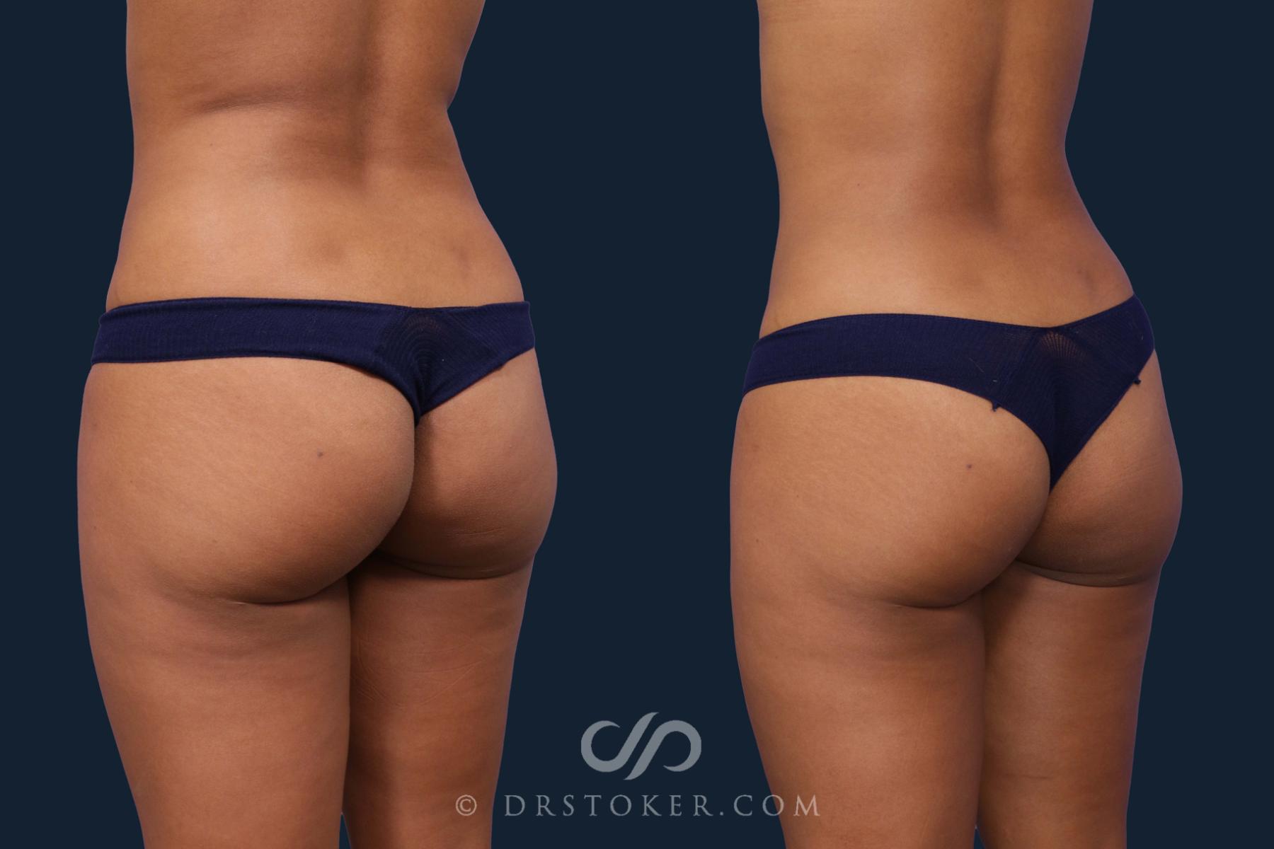 Before & After Brazilian Butt Lift (Fat Grafts to Buttocks) Case 2040 Left Oblique View in Los Angeles, CA
