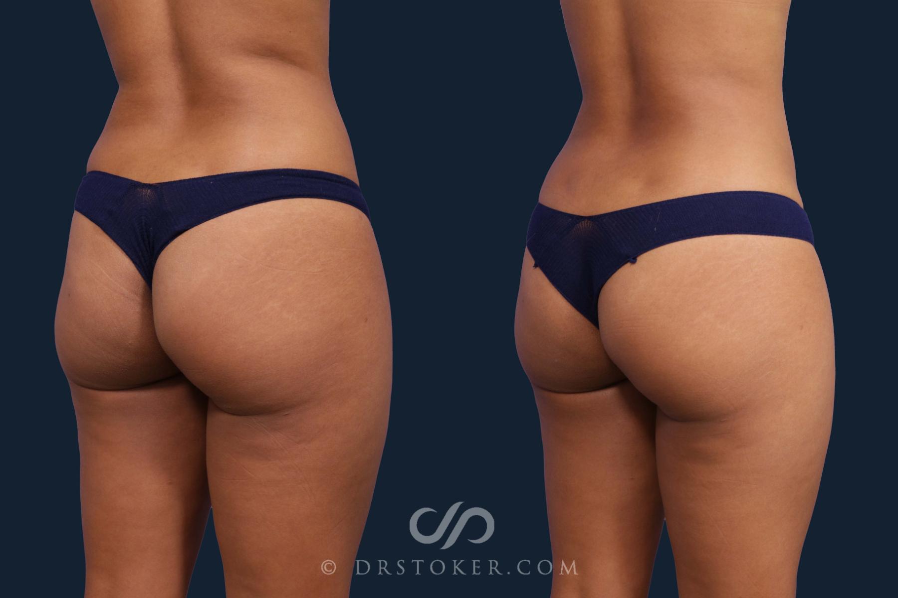 Before & After Brazilian Butt Lift (Fat Grafts to Buttocks) Case 2040 Right Oblique View in Los Angeles, CA