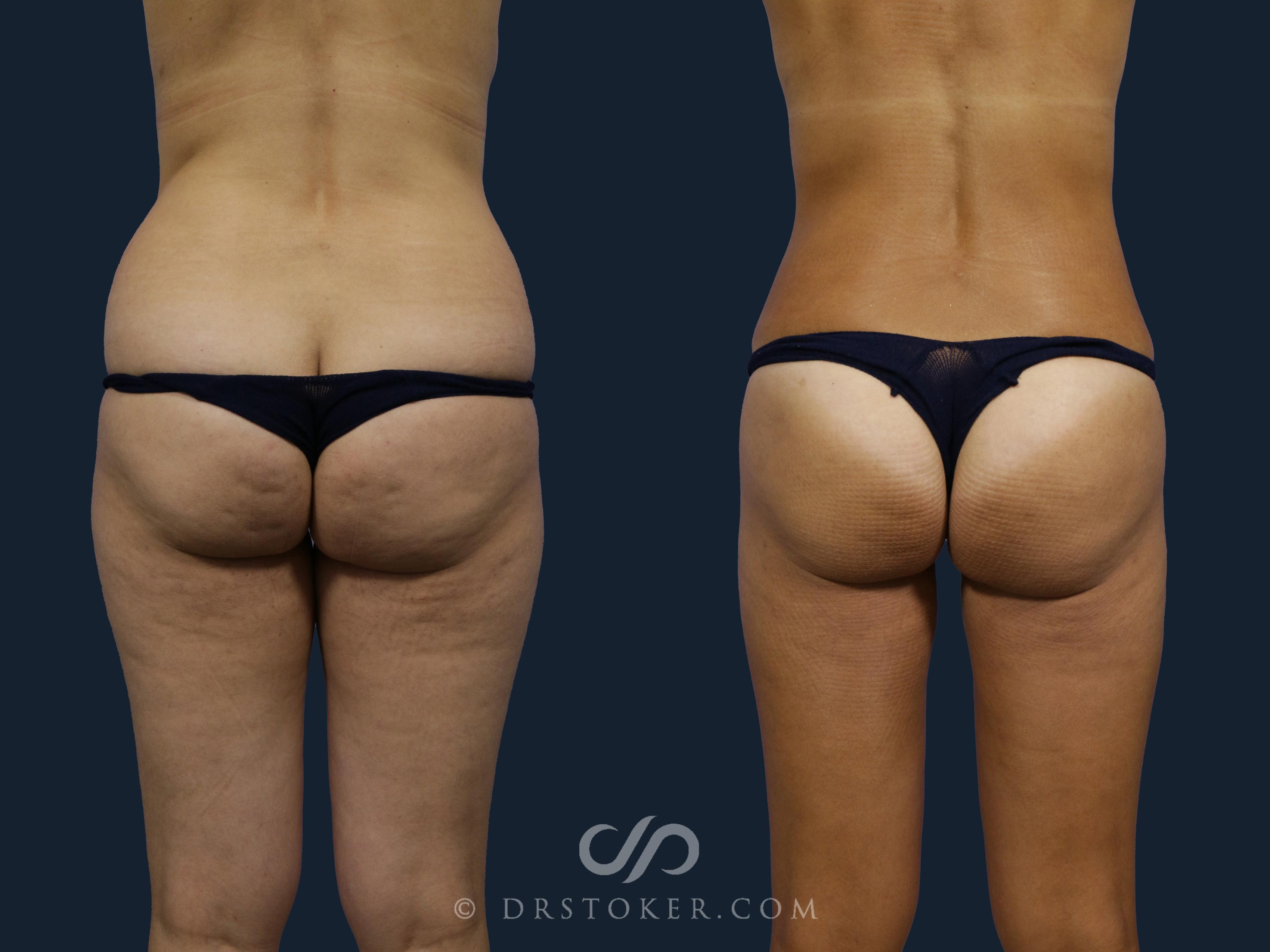 Brazilian Butt Lift (Fat Grafts to Buttocks) Before and After