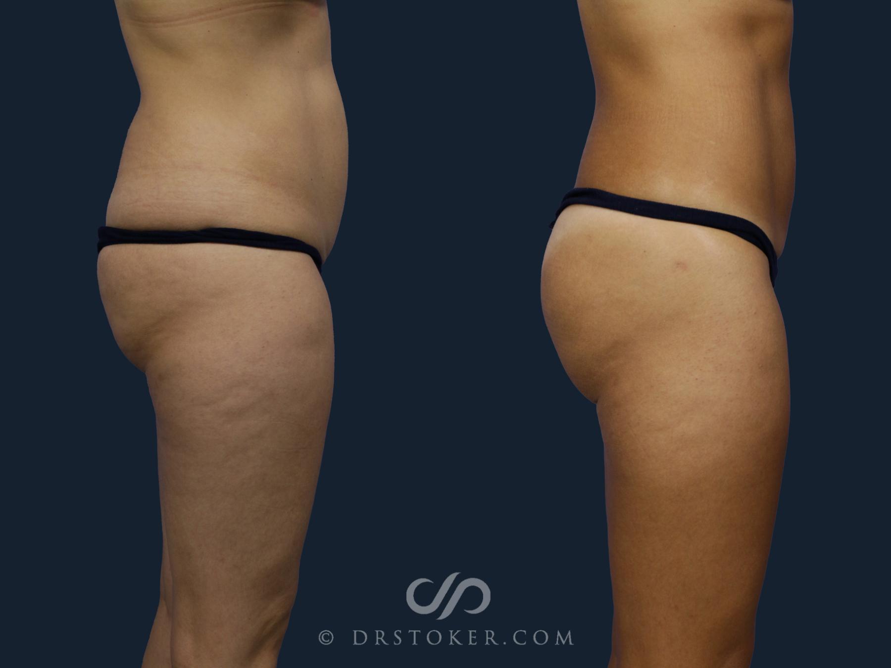 Before & After Brazilian Butt Lift (Fat Grafts to Buttocks) Case 2050 Right Side View in Los Angeles, CA