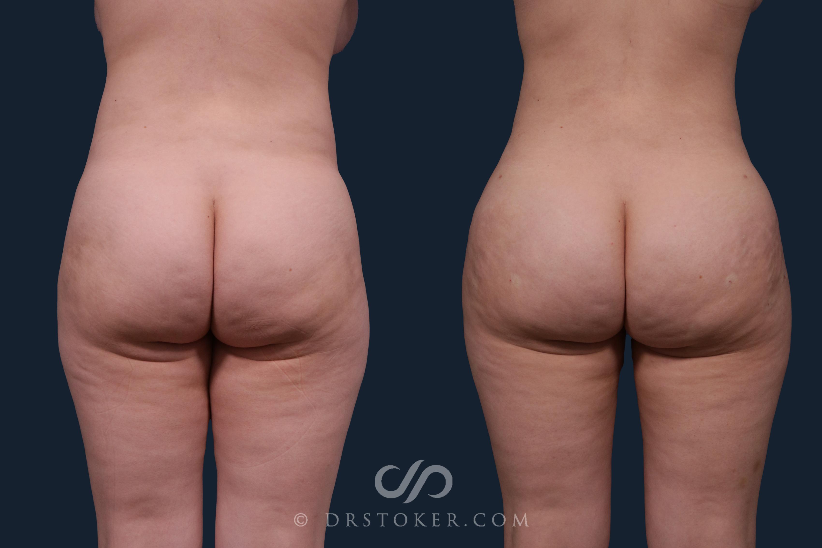 Before & After Brazilian Butt Lift (Fat Grafts to Buttocks) Case 2172 Back View in Los Angeles, CA
