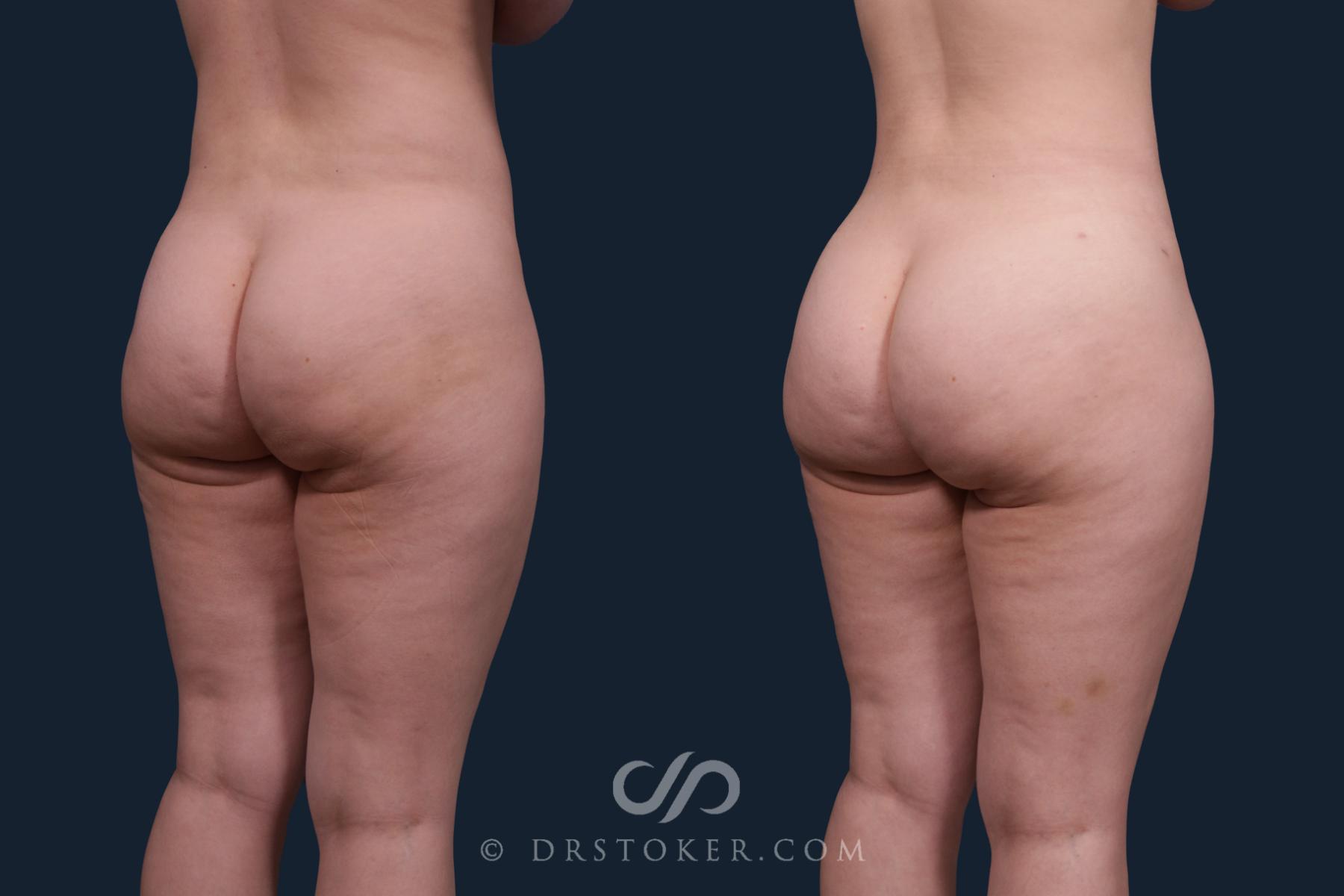 Before & After Brazilian Butt Lift (Fat Grafts to Buttocks) Case 2172 Right Oblique View in Los Angeles, CA