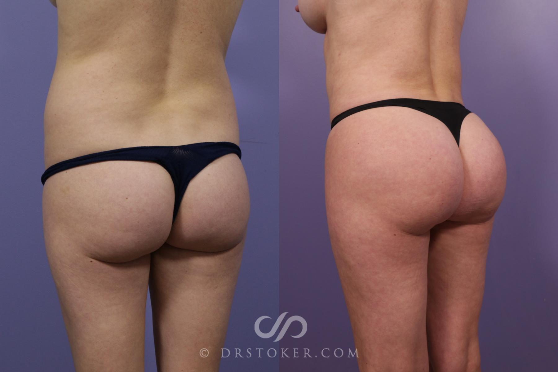 Before & After Brazilian Butt Lift (Fat Grafts to Buttocks) Case 2610 Left Oblique View in Los Angeles, CA