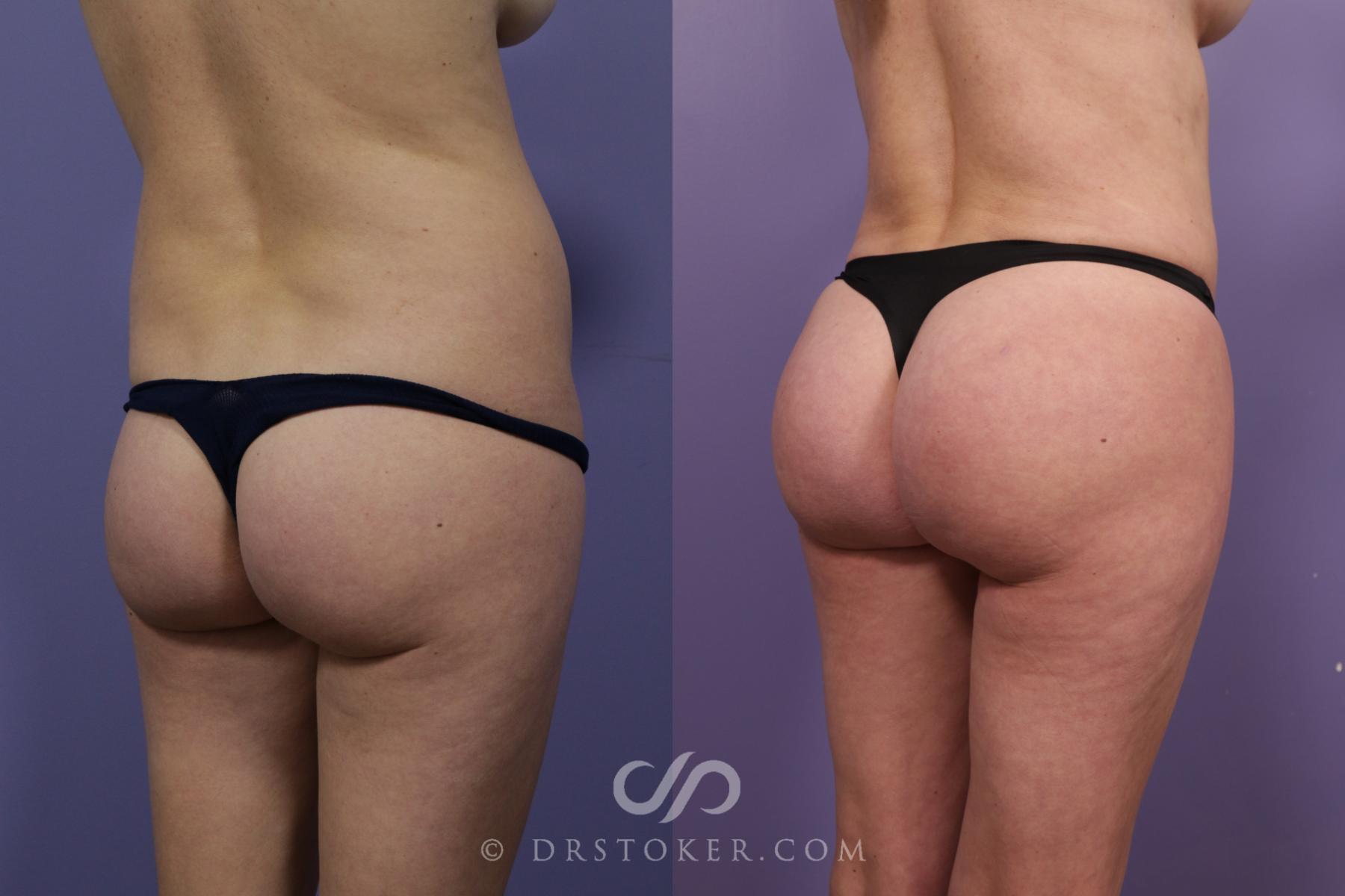 Before & After Brazilian Butt Lift (Fat Grafts to Buttocks) Case 2610 Right Oblique View in Los Angeles, CA