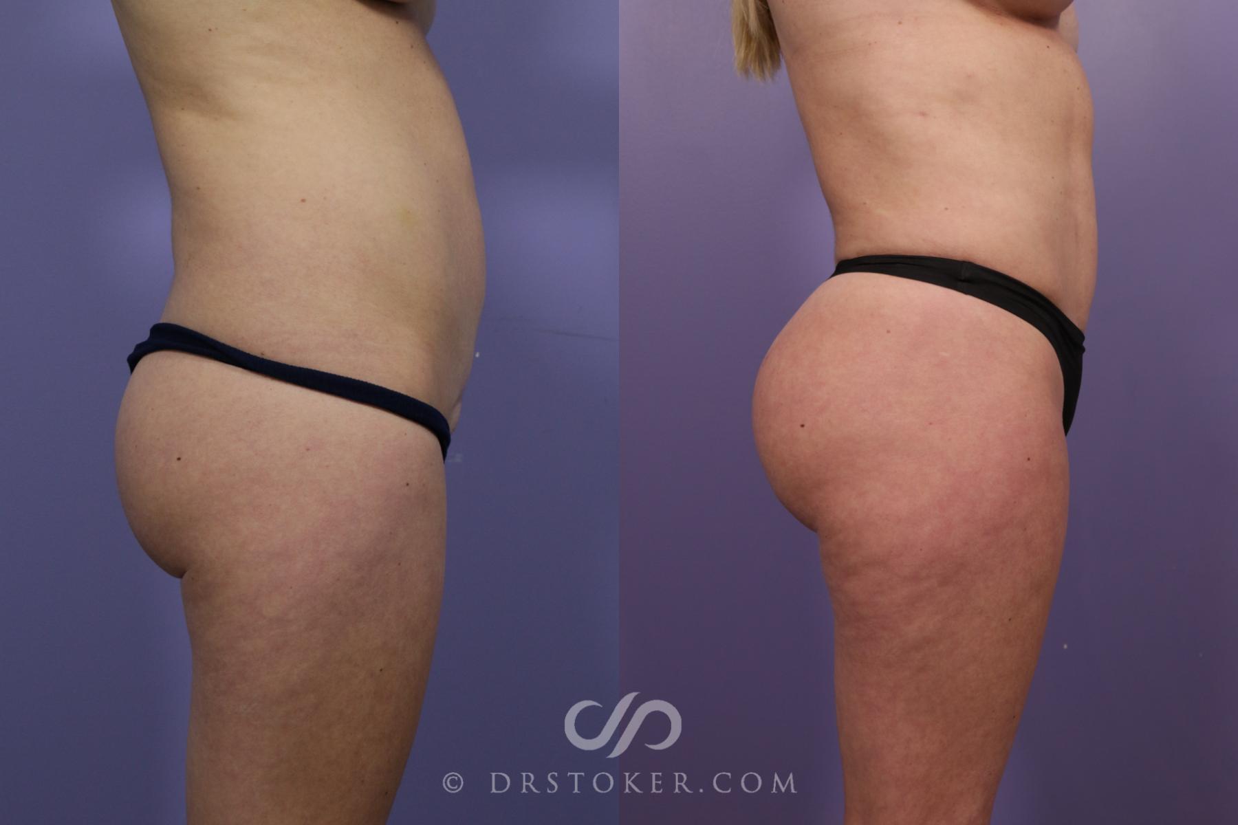 Before & After Brazilian Butt Lift (Fat Grafts to Buttocks) Case 2610 Right Side View in Los Angeles, CA