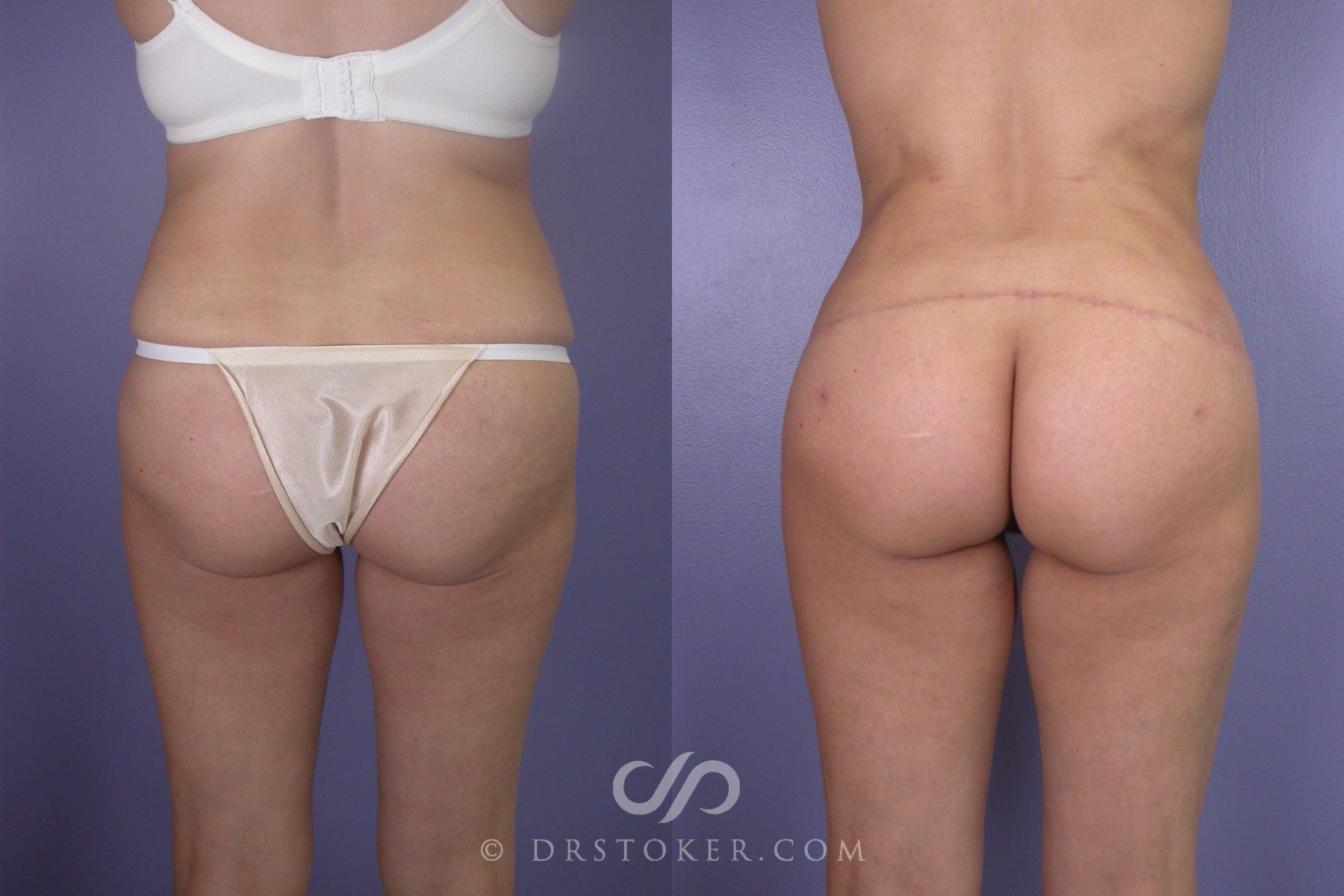 Before & After Brazilian Butt Lift (Fat Grafts to Buttocks) Case 553 View #1 View in Los Angeles, CA