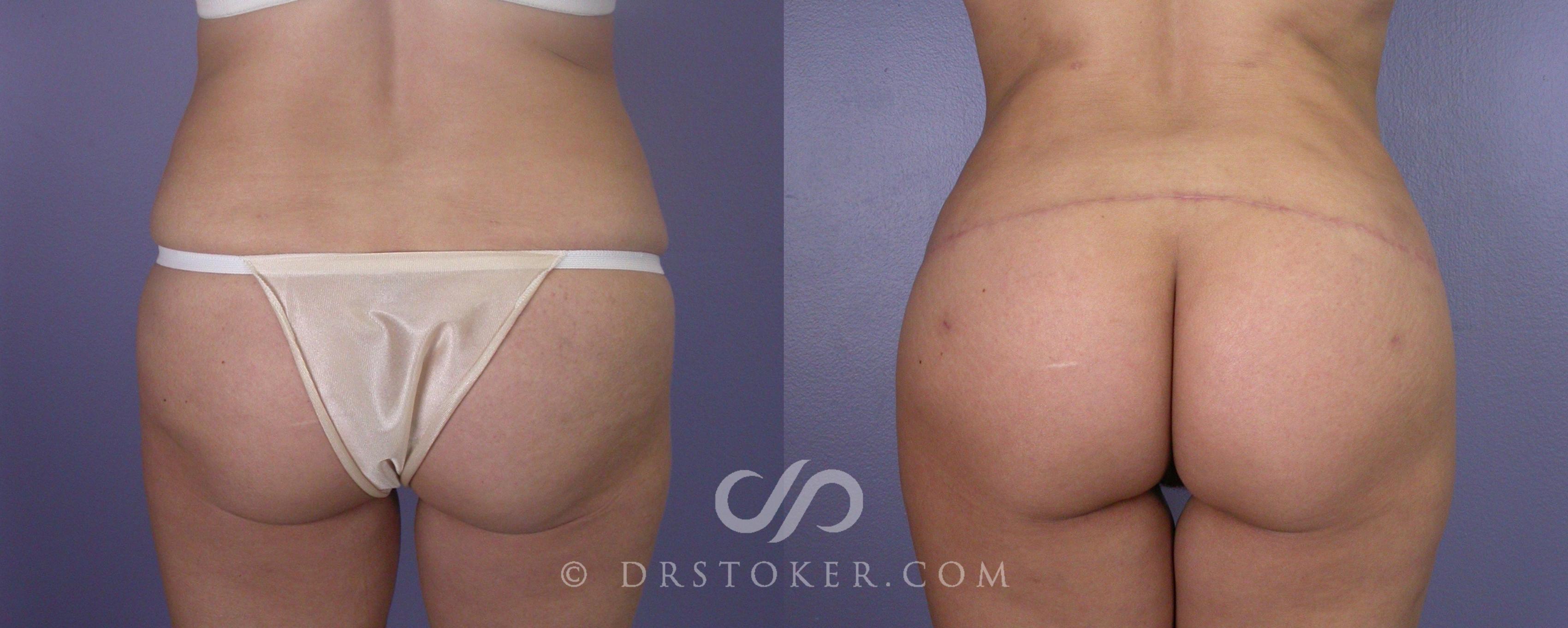 Before & After Brazilian Butt Lift (Fat Grafts to Buttocks) Case 554 View #1 View in Los Angeles, CA