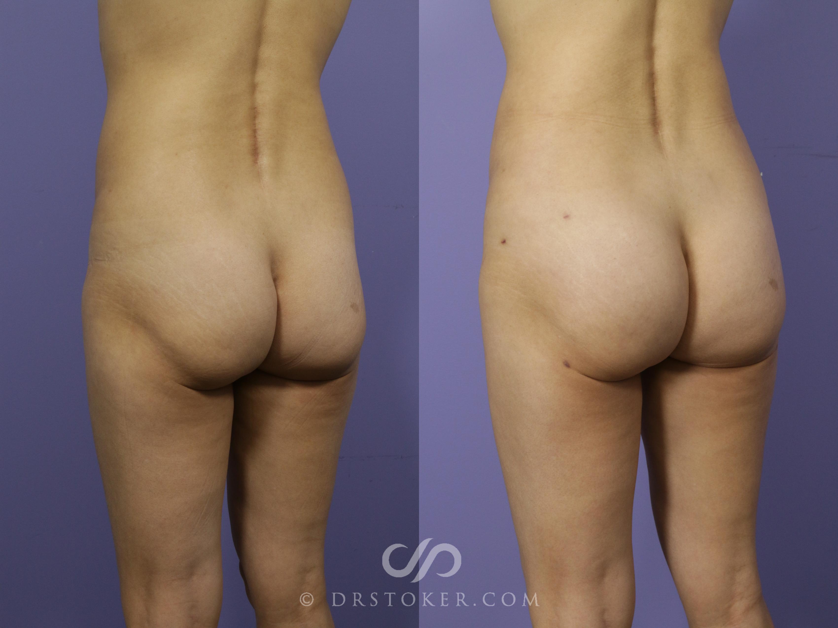Before & After Brazilian Butt Lift (Fat Grafts to Buttocks) Case 556 View #1 View in Los Angeles, CA