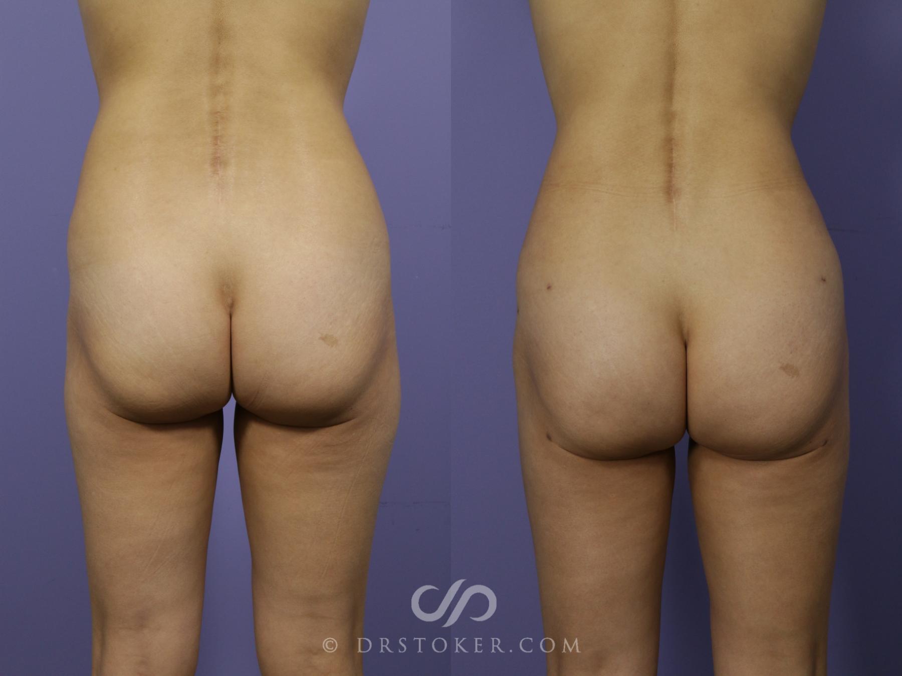 Before & After Brazilian Butt Lift (Fat Grafts to Buttocks) Case 556 View #2 View in Los Angeles, CA