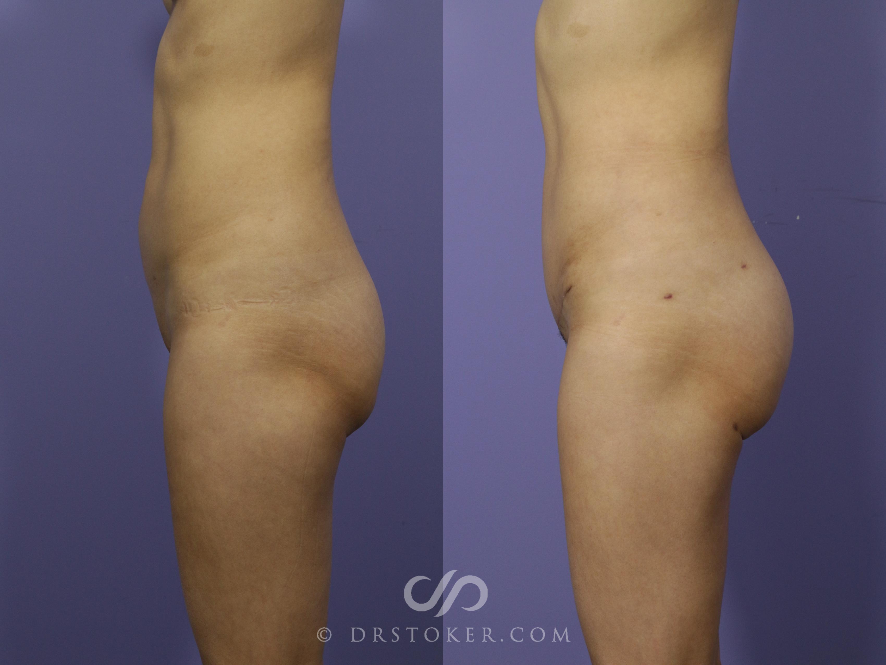 Before & After Brazilian Butt Lift (Fat Grafts to Buttocks) Case 557 View #1 View in Los Angeles, CA