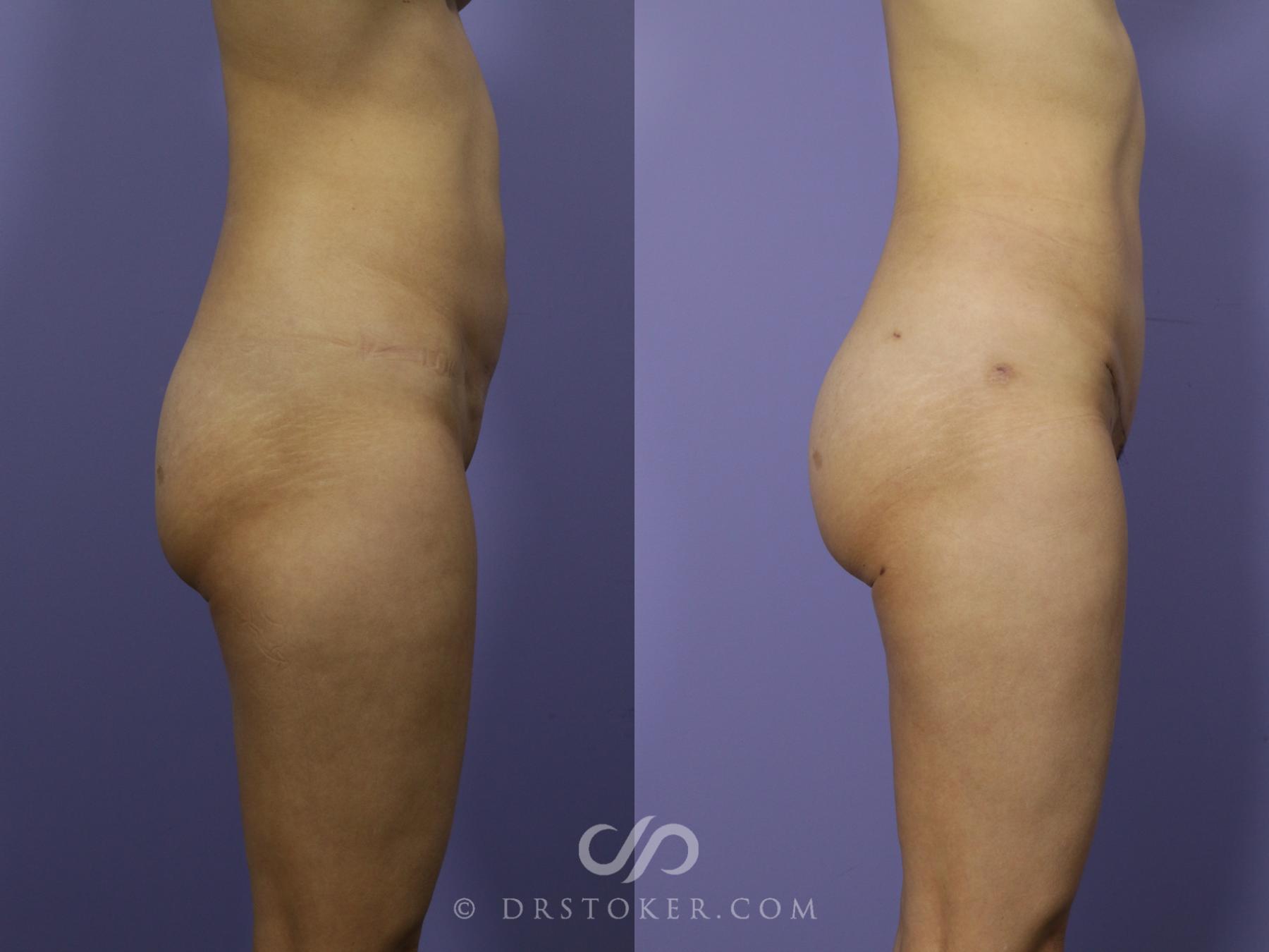 Before & After Brazilian Butt Lift (Fat Grafts to Buttocks) Case 558 View #1 View in Los Angeles, CA