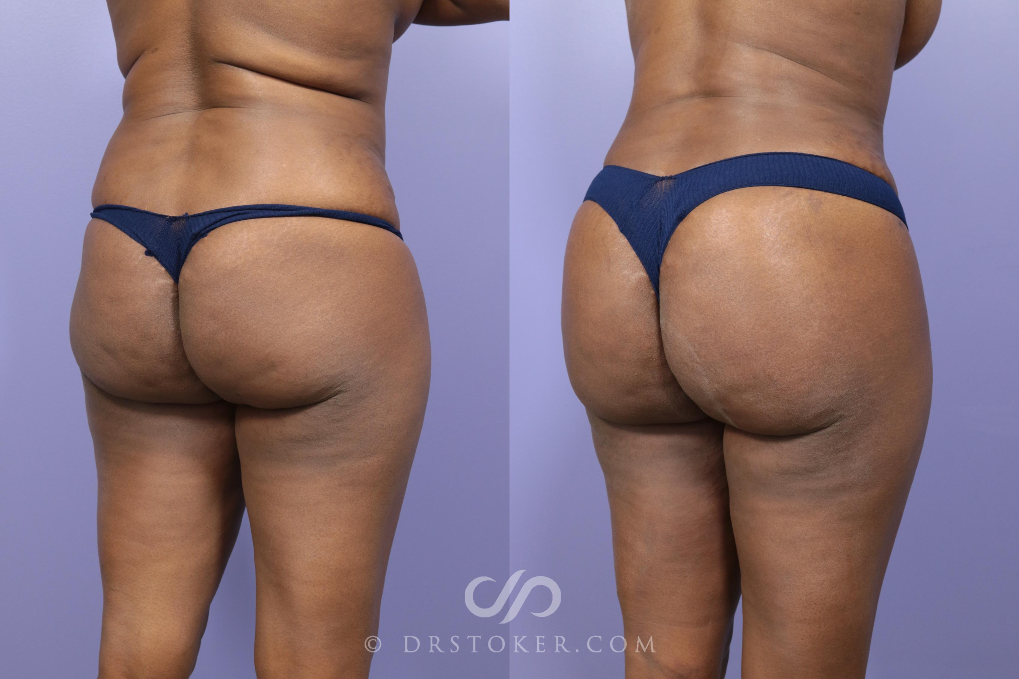 Brazilian Butt Lift (Fat Grafts to Buttocks) Before and After Pictures Case  560, Los Angeles, CA
