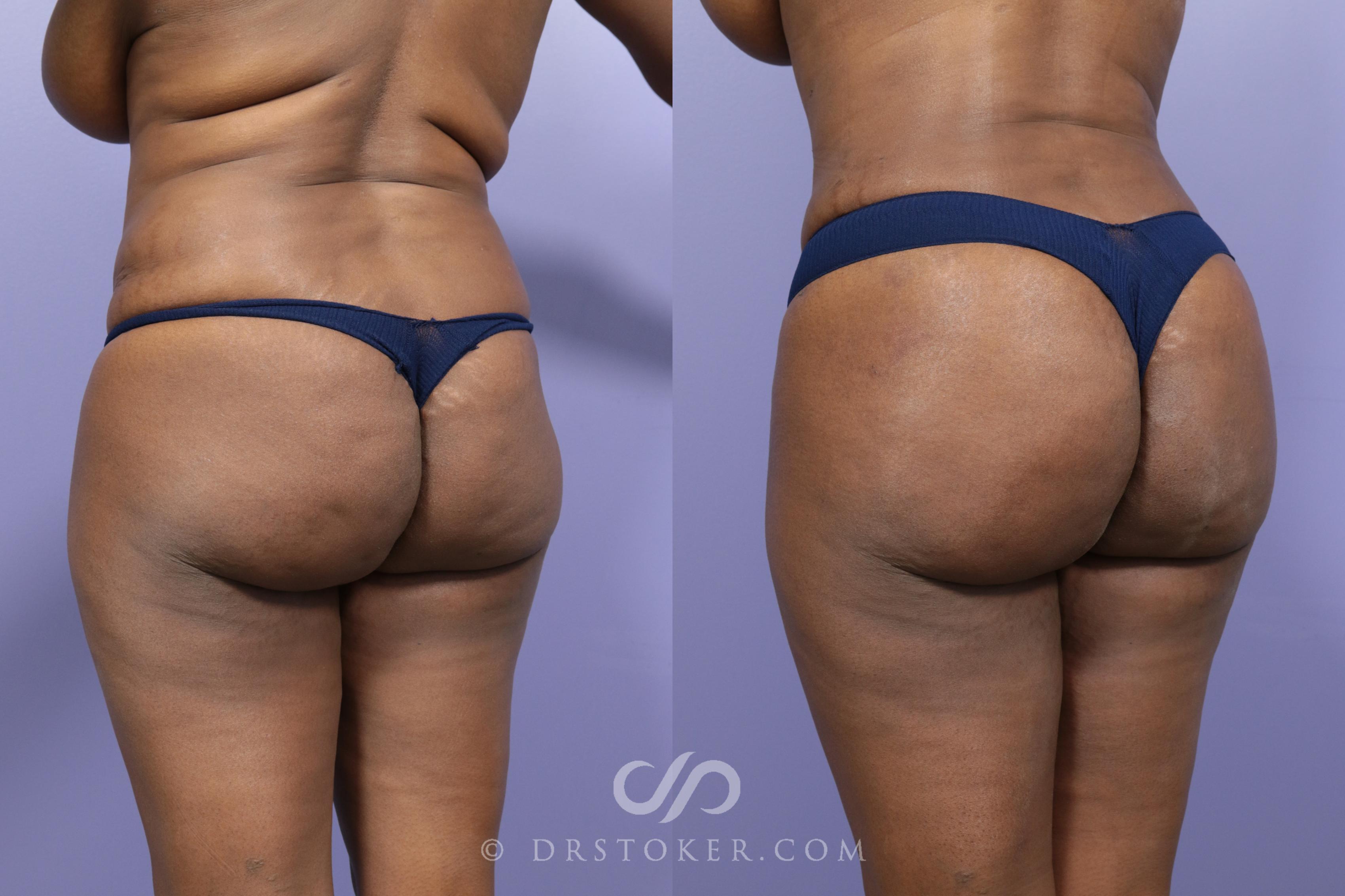 Before & After Brazilian Butt Lift (Fat Grafts to Buttocks) Case 561 View #1 View in Los Angeles, CA