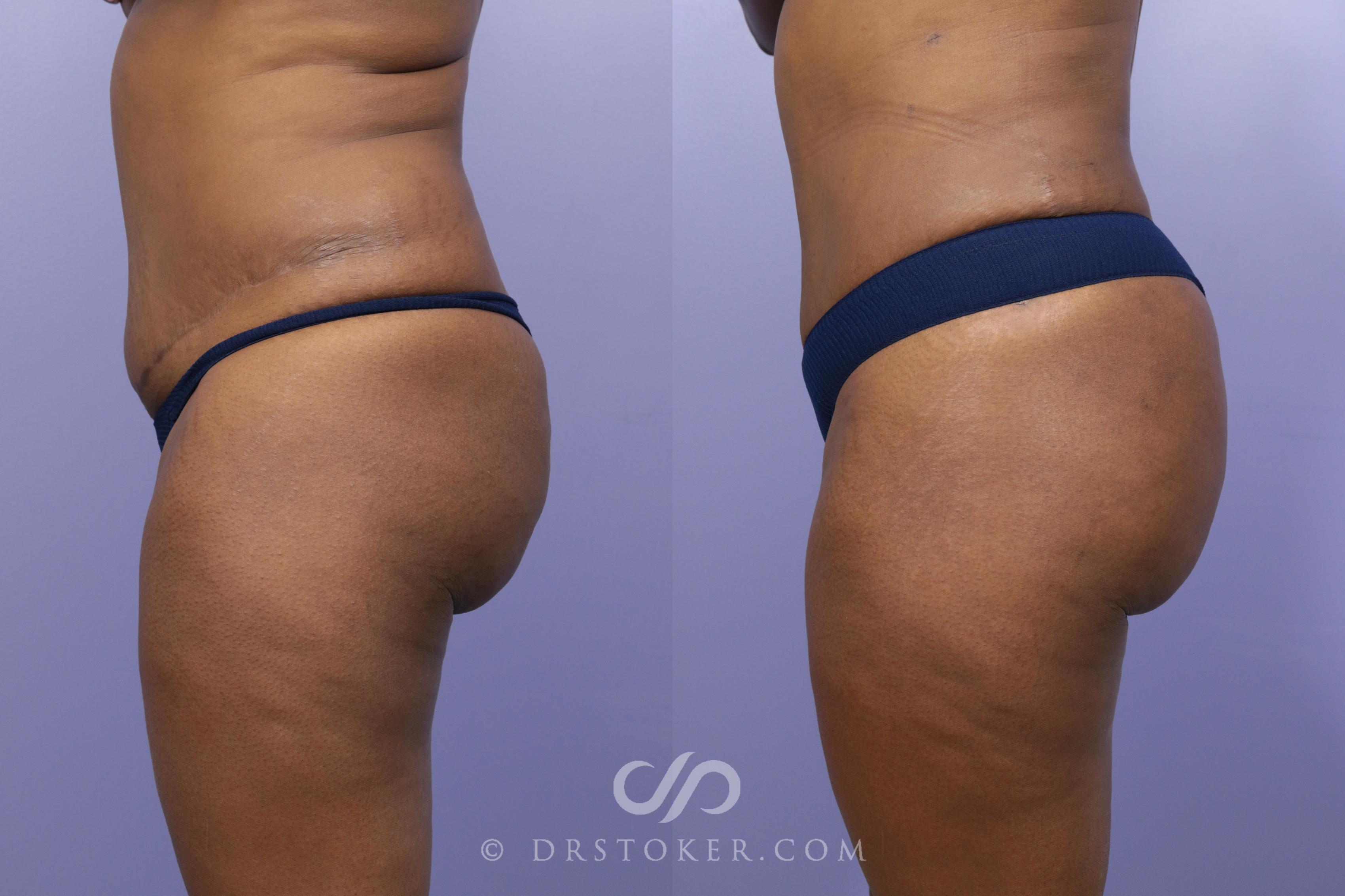 Before & After Brazilian Butt Lift (Fat Grafts to Buttocks) Case 562 View #1 View in Los Angeles, CA
