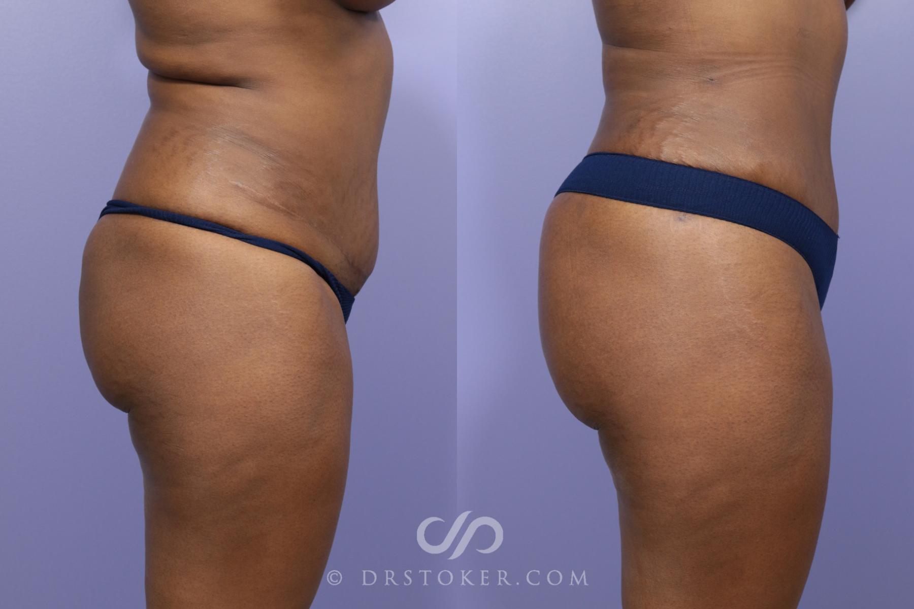 Before & After Brazilian Butt Lift (Fat Grafts to Buttocks) Case 563 View #1 View in Los Angeles, CA