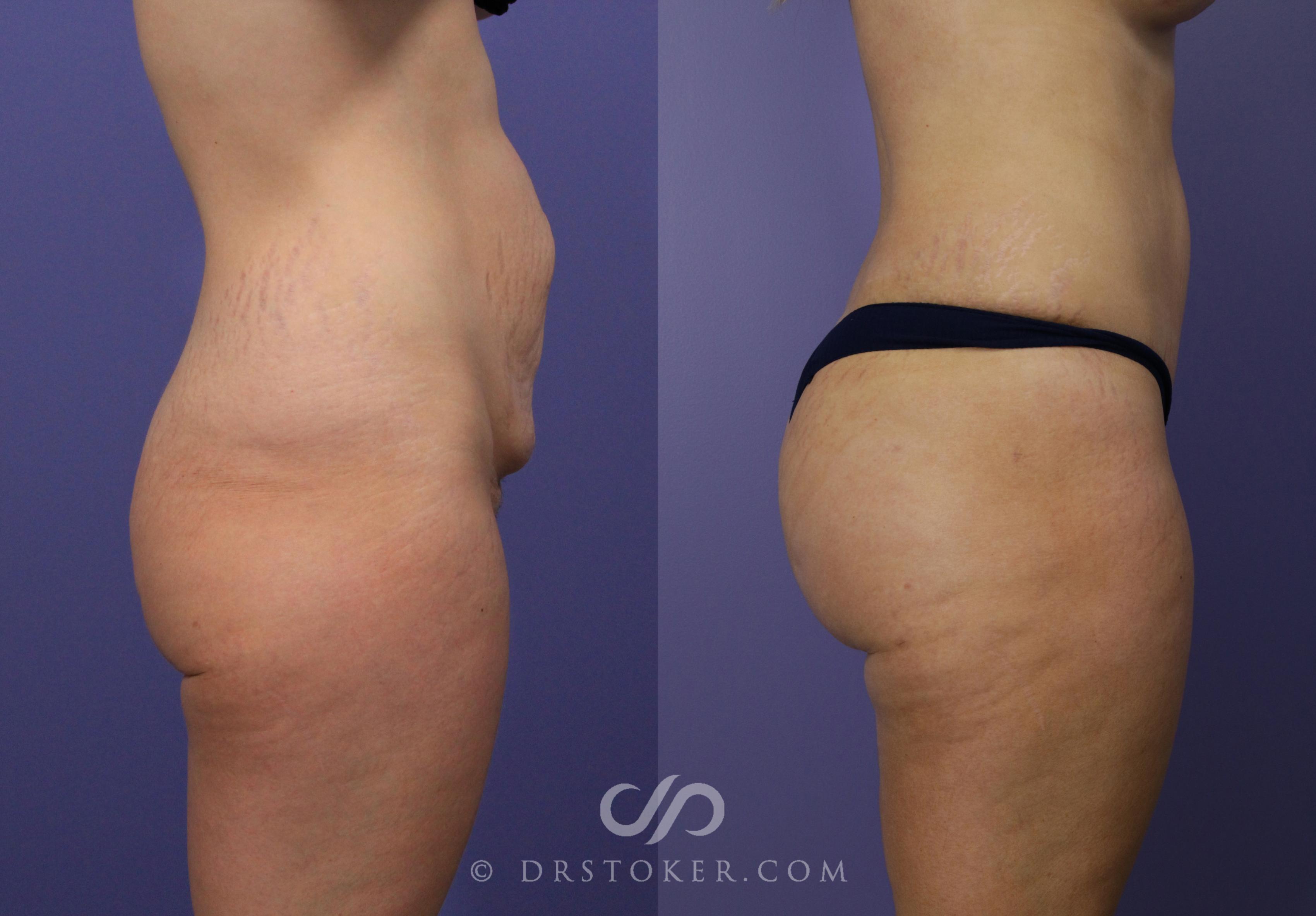 Before & After Brazilian Butt Lift (Fat Grafts to Buttocks) Case 565 View #1 View in Los Angeles, CA