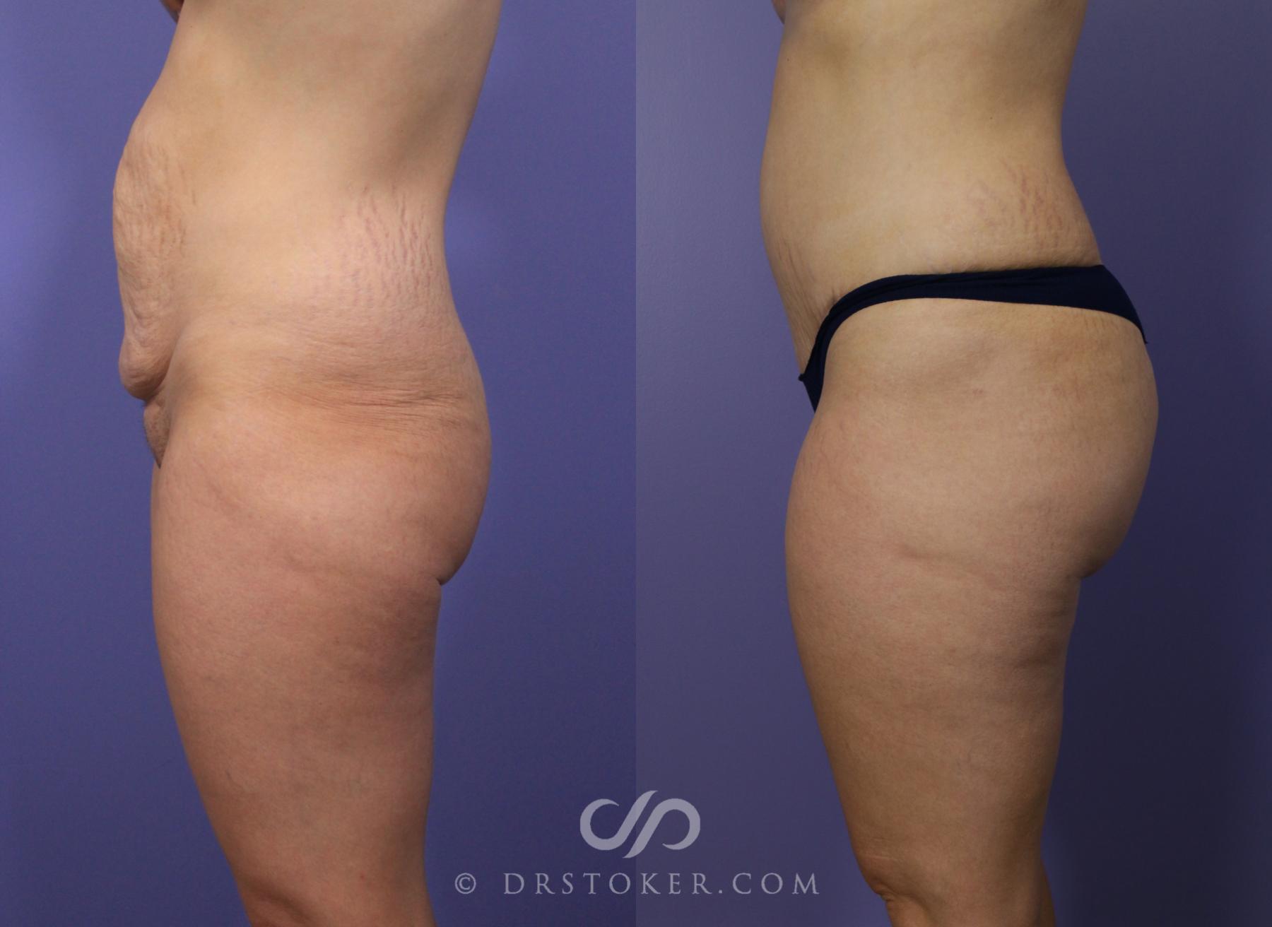 Before & After Brazilian Butt Lift (Fat Grafts to Buttocks) Case 566 View #1 View in Los Angeles, CA