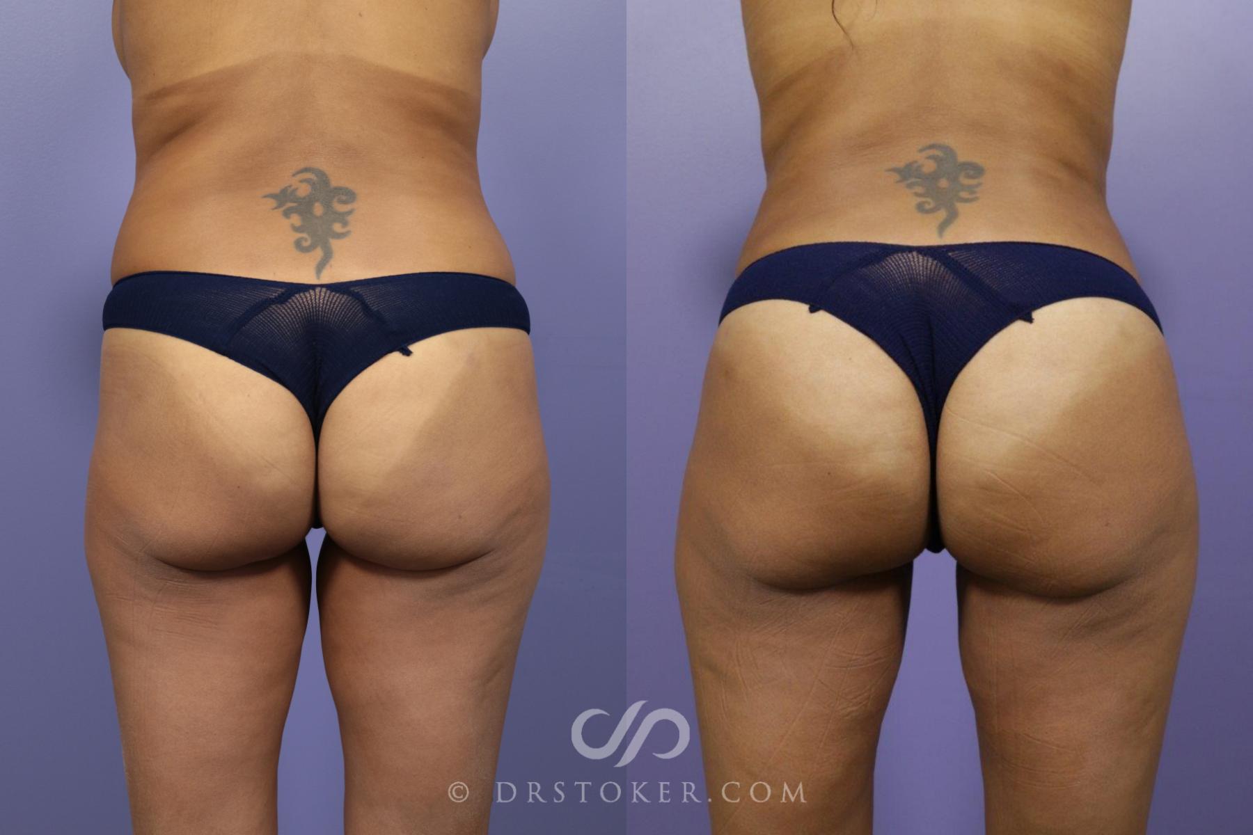 Before & After Brazilian Butt Lift (Fat Grafts to Buttocks) Case 570 View #1 View in Los Angeles, CA