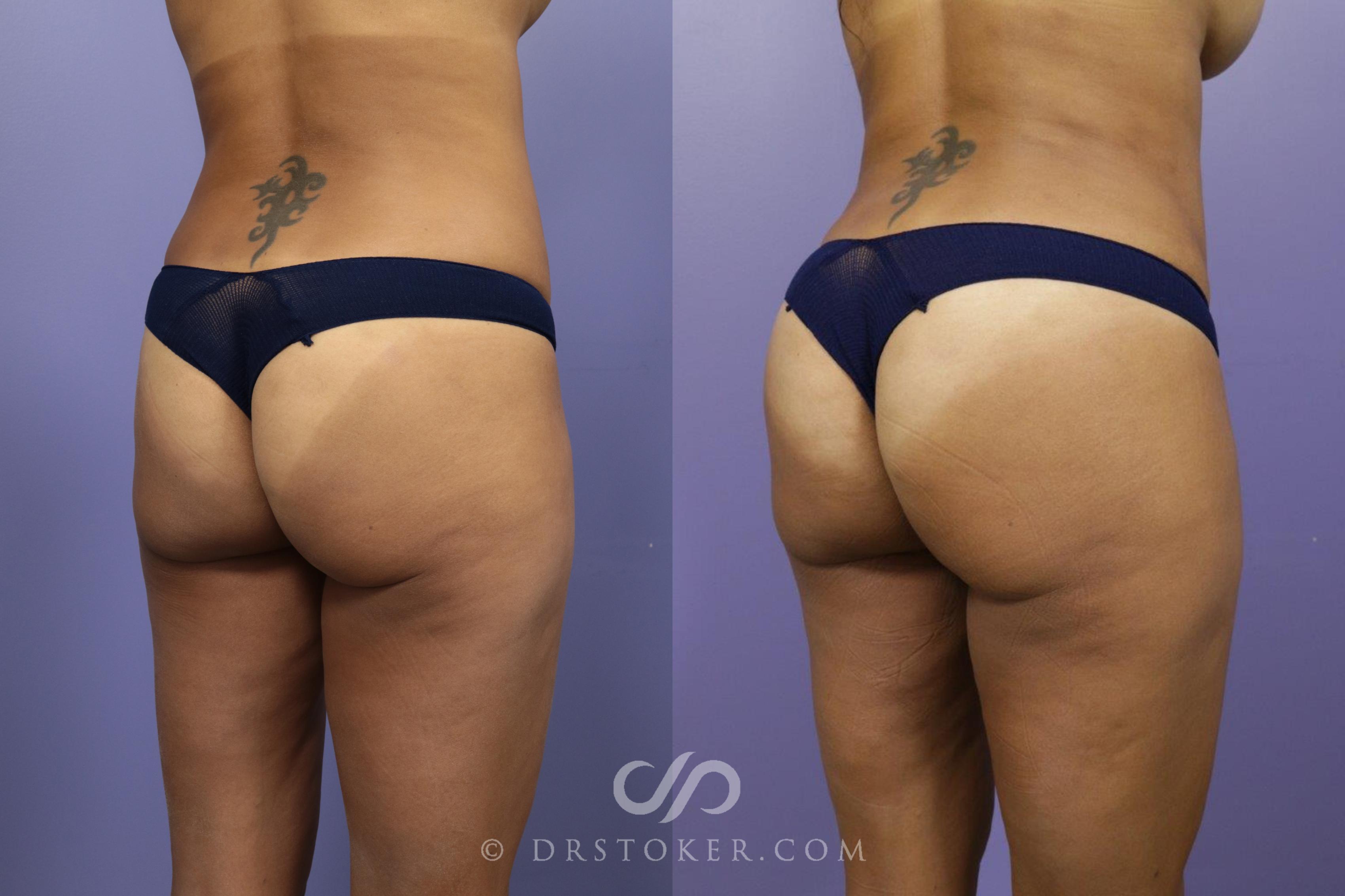 brazilian butt lift before and after