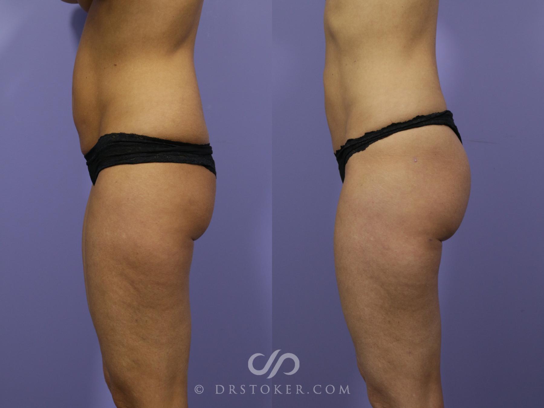 Before & After Brazilian Butt Lift (Fat Grafts to Buttocks) Case 571 View #1 View in Los Angeles, CA