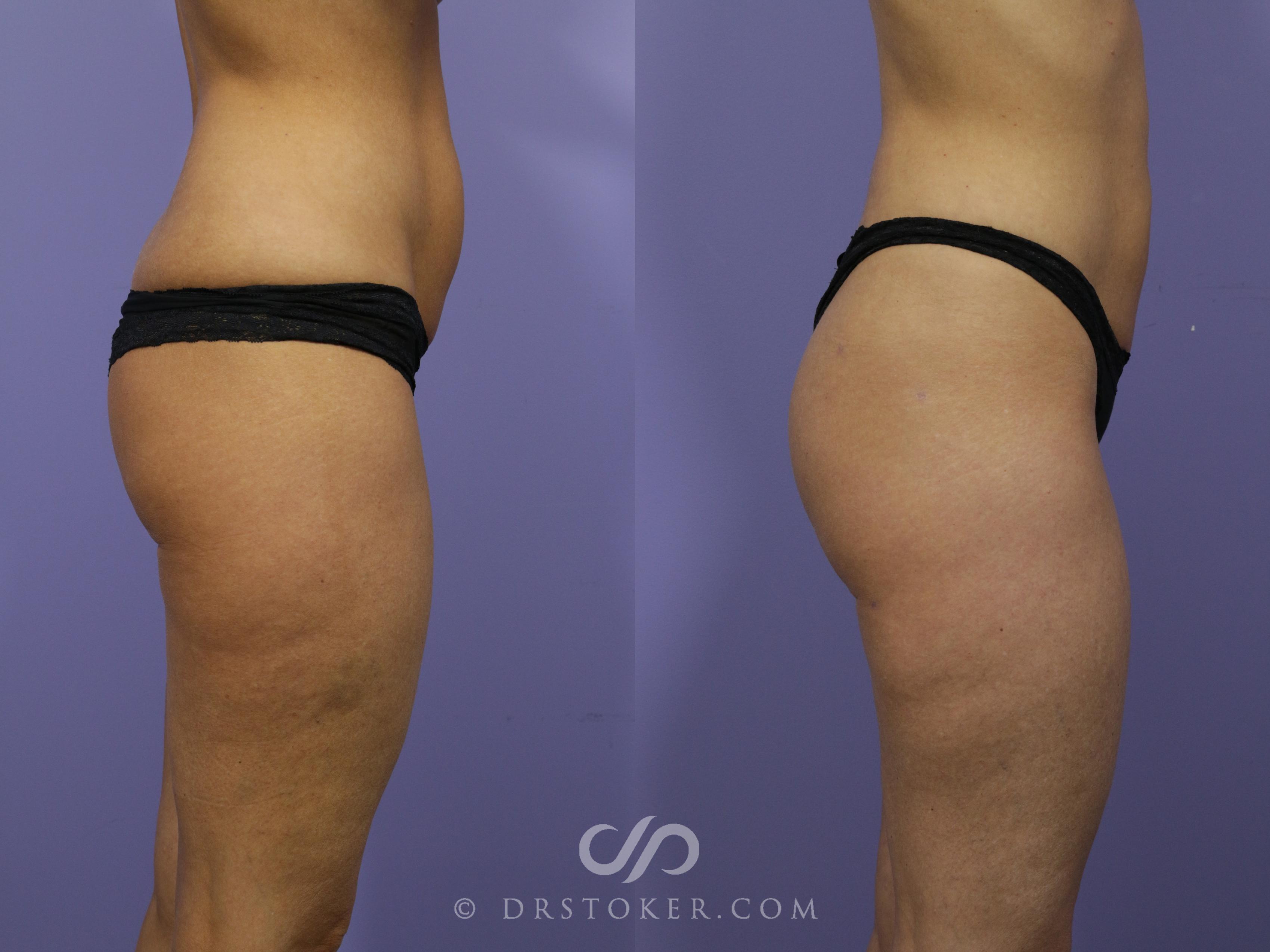 Before & After Brazilian Butt Lift (Fat Grafts to Buttocks) Case 572 View #1 View in Los Angeles, CA