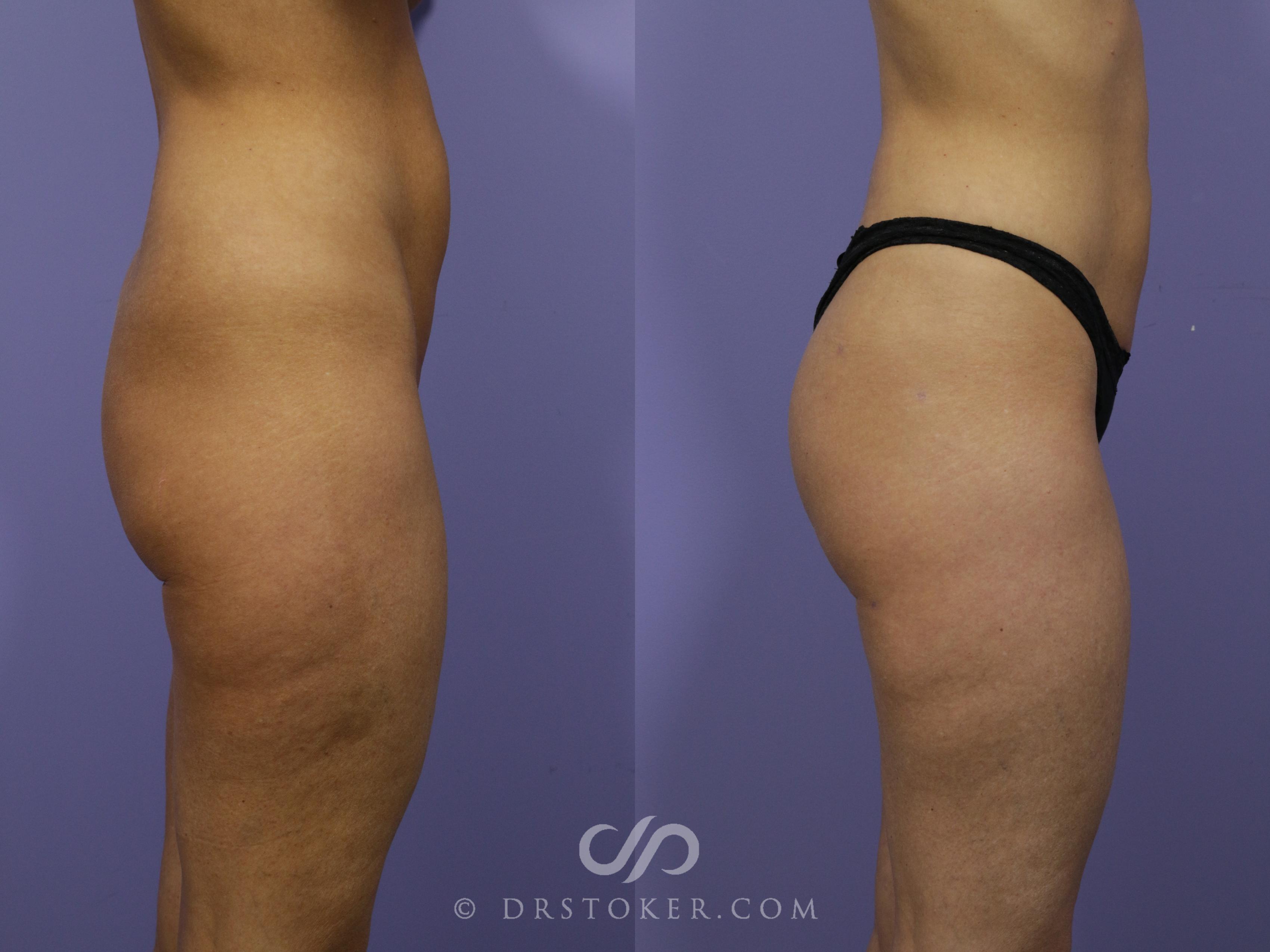 Before & After Brazilian Butt Lift (Fat Grafts to Buttocks) Case 573 View #1 View in Los Angeles, CA