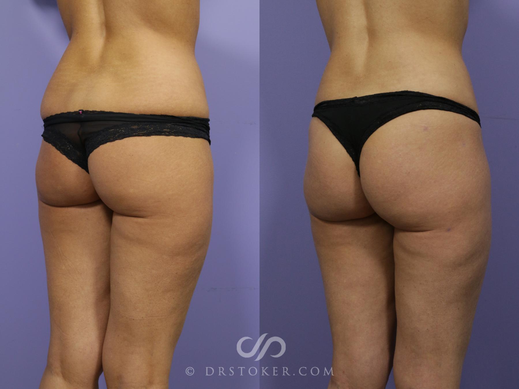 Before & After Brazilian Butt Lift (Fat Grafts to Buttocks) Case 574 View #1 View in Los Angeles, CA