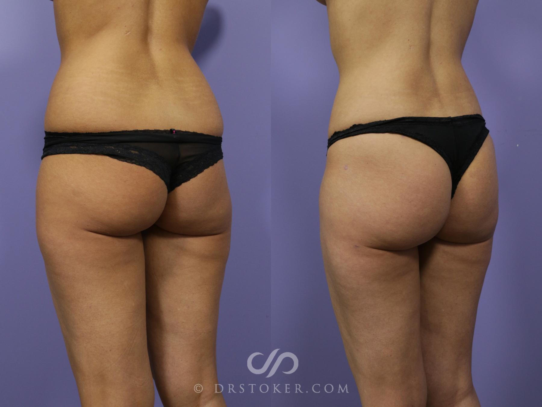 Before & After Brazilian Butt Lift (Fat Grafts to Buttocks) Case 575 View #1 View in Los Angeles, CA