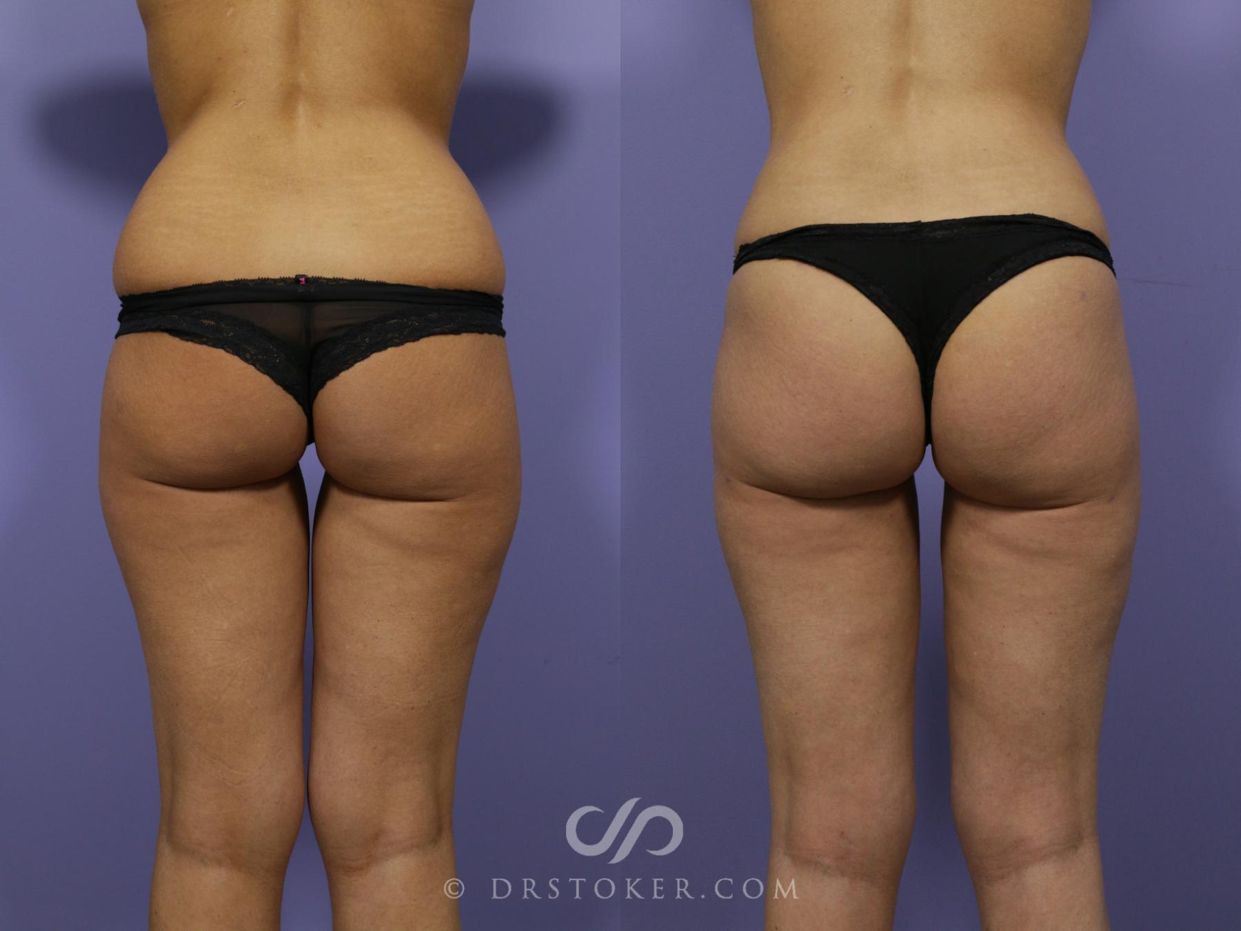 Before & After Brazilian Butt Lift (Fat Grafts to Buttocks) Case 576 View #1 View in Los Angeles, CA