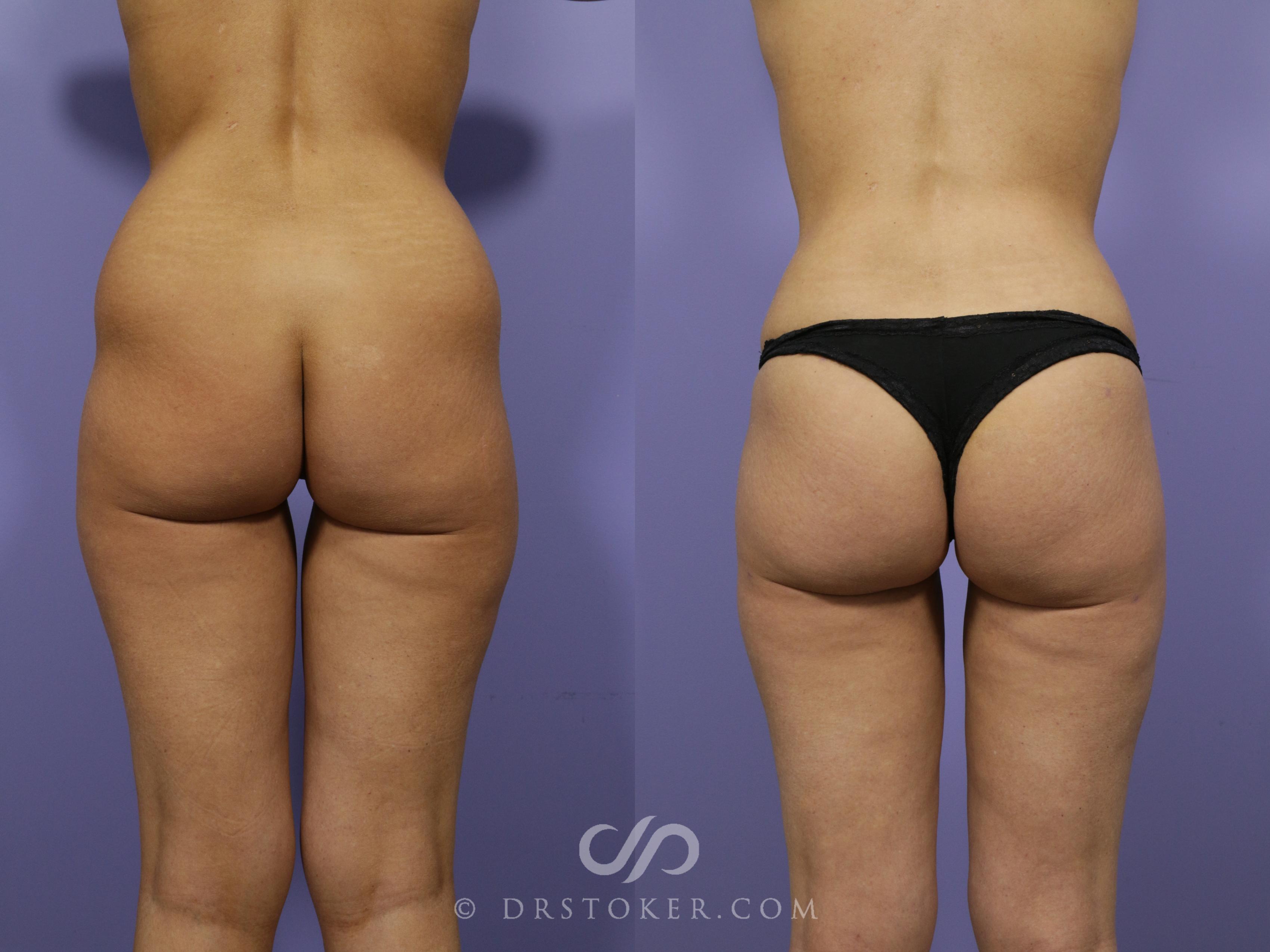 Before & After Brazilian Butt Lift (Fat Grafts to Buttocks) Case 577 View #1 View in Los Angeles, CA