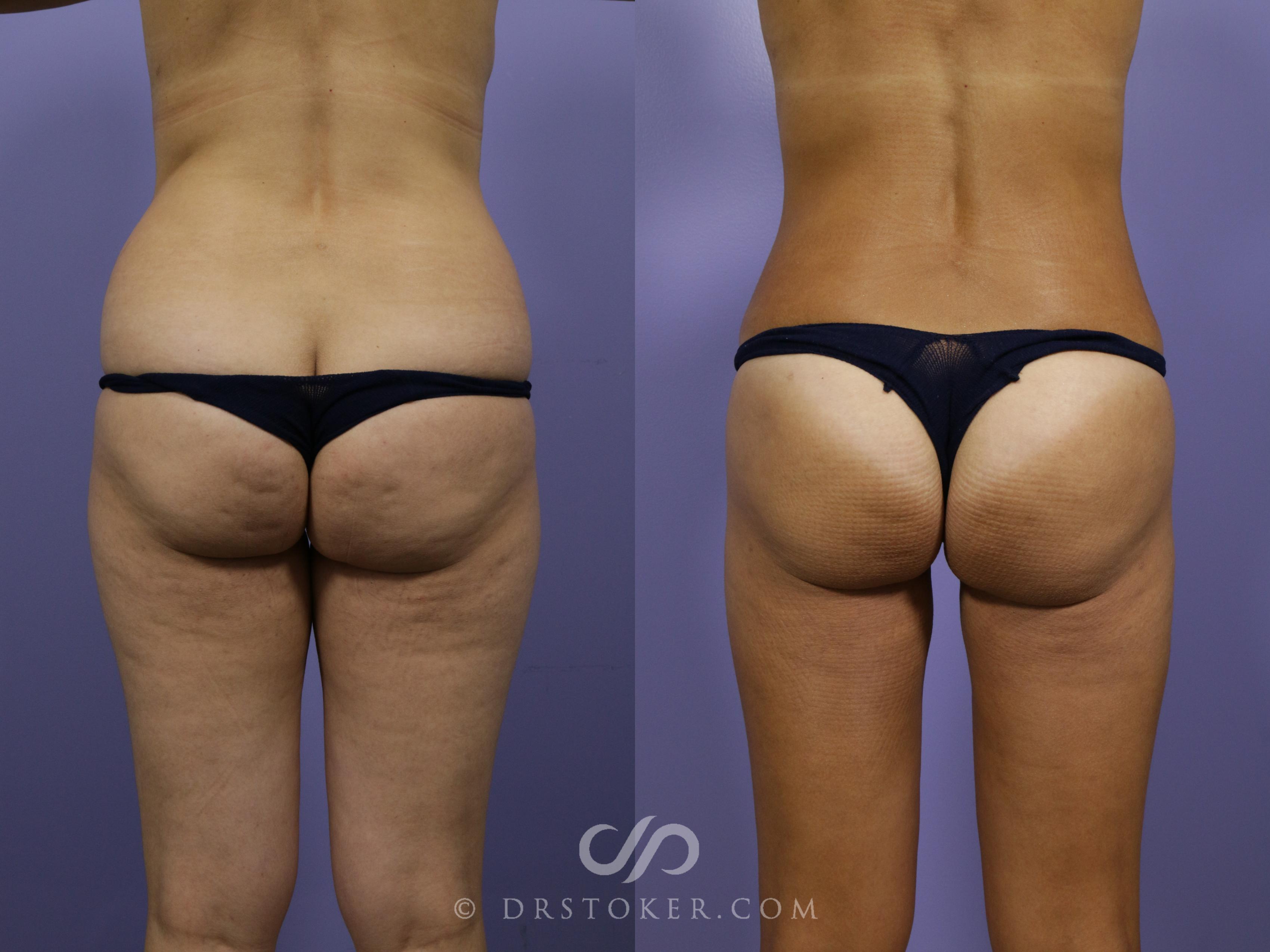Before & After Brazilian Butt Lift (Fat Grafts to Buttocks) Case 578 View #1 View in Los Angeles, CA