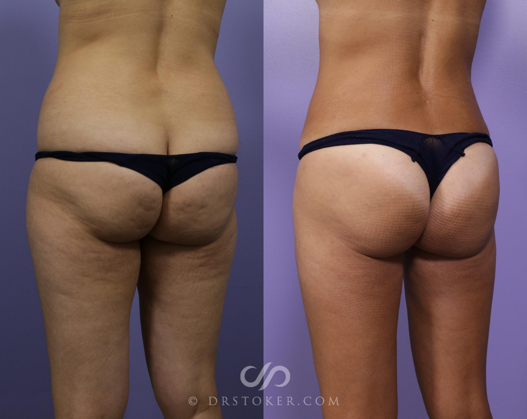 Before & After Brazilian Butt Lift (Fat Grafts to Buttocks) Case 579 View #1 View in Los Angeles, CA