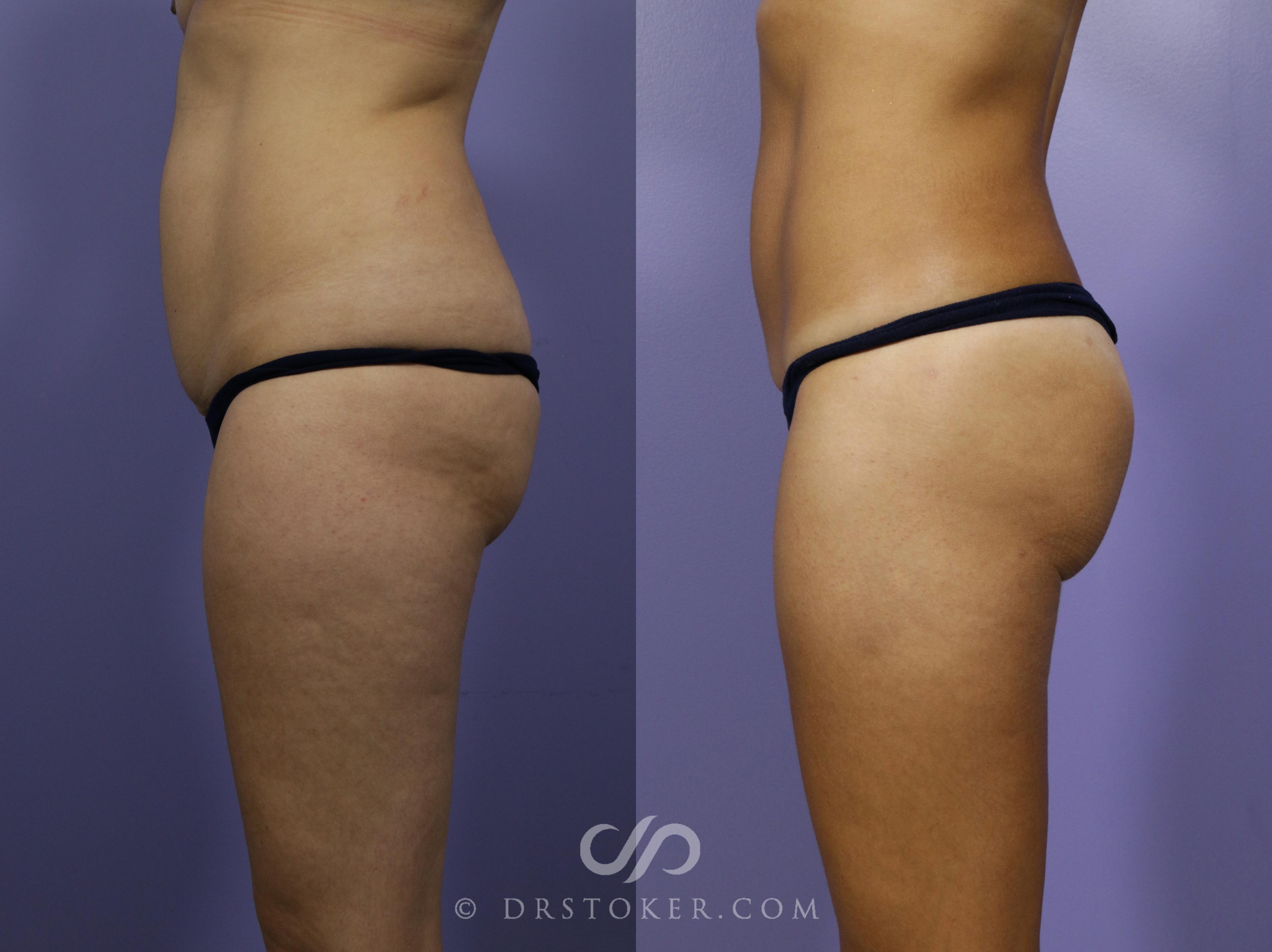 Before & After Brazilian Butt Lift (Fat Grafts to Buttocks) Case 580 View #1 View in Los Angeles, CA