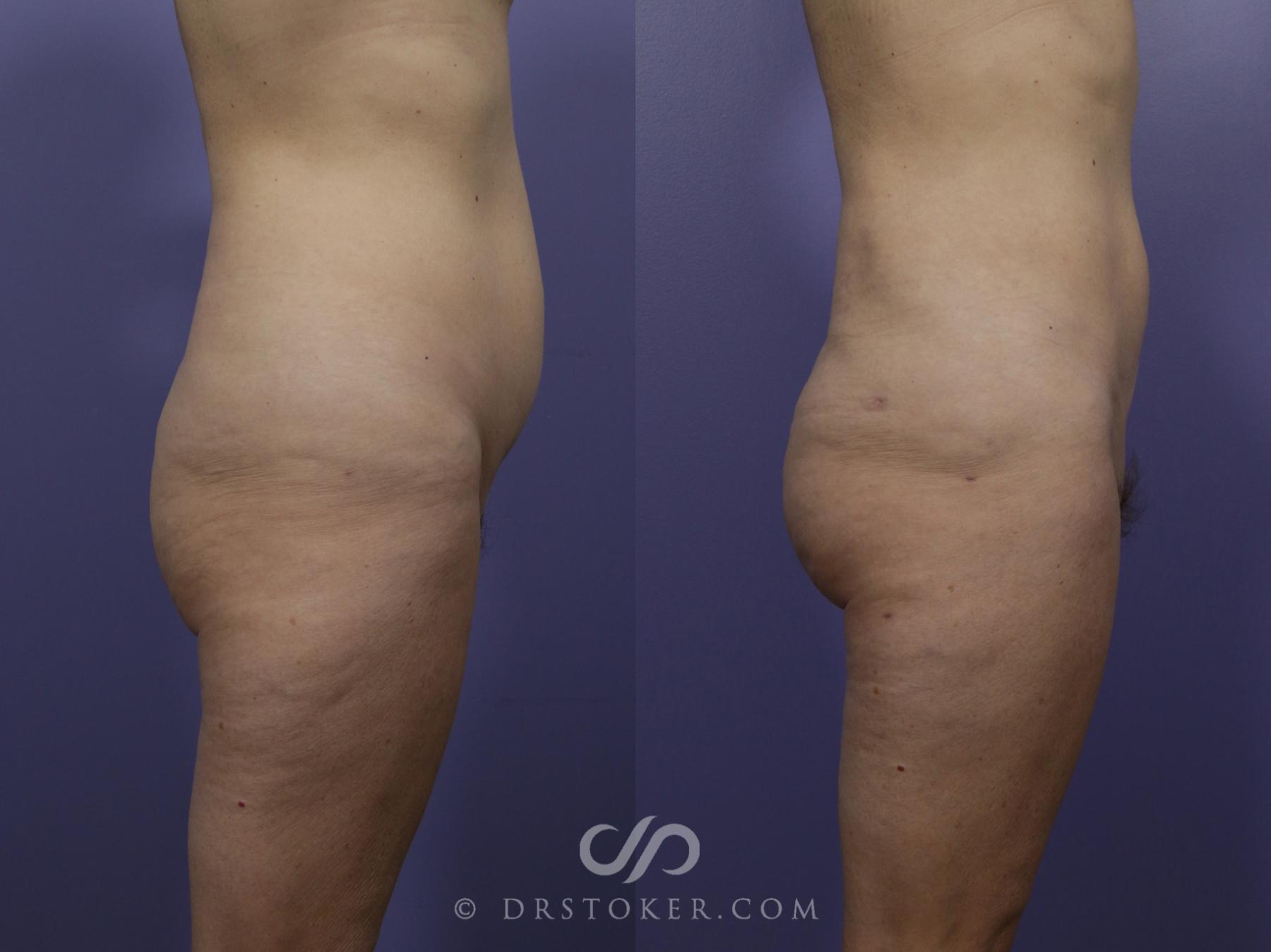 Before & After Brazilian Butt Lift (Fat Grafts to Buttocks) Case 581 View #1 View in Los Angeles, CA