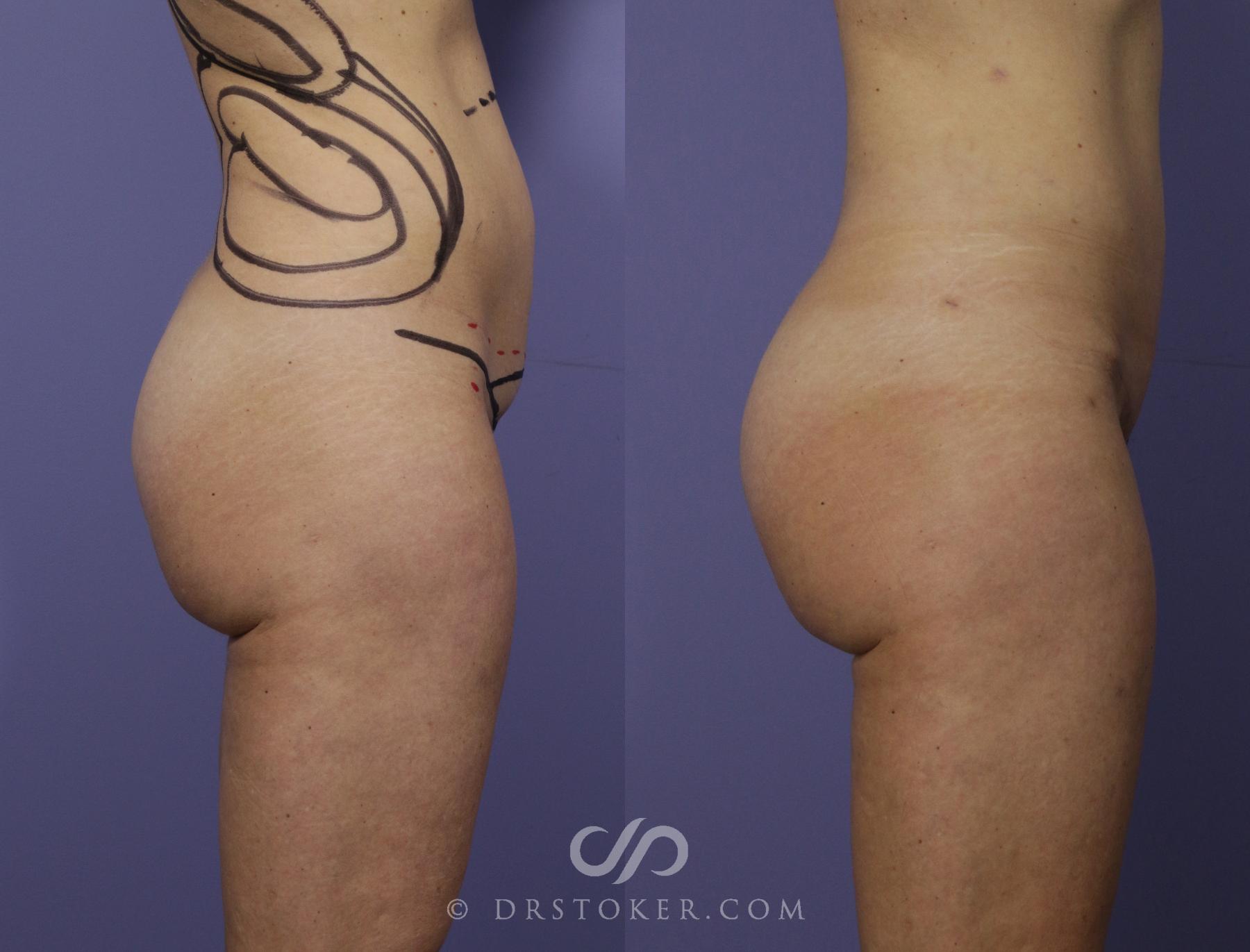 Before & After Brazilian Butt Lift (Fat Grafts to Buttocks) Case 582 View #2 View in Los Angeles, CA